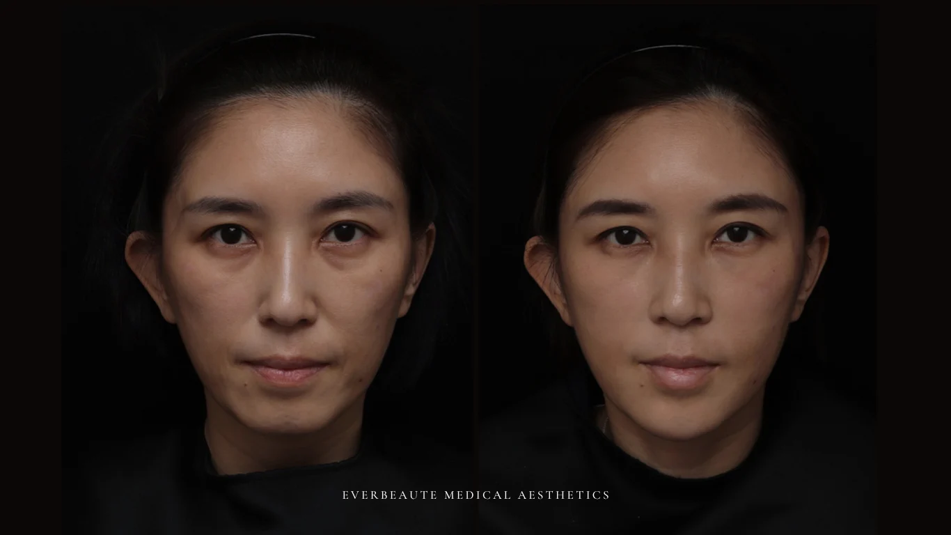 台北醫美推薦 大安區醫美 桃園微整 淚溝 眼袋 黑眼圈 豐唇 木偶紋 凝境美學診所 曾繁聞醫師 于曉恩醫師 皮膚科 專科 專業 效果自然 微整形 填補 填充 瑞士緹奧希 玻尿酸 喬雅登 水無痕 保柔緹 女神動態 熊貓針 淚溝針 童顏針 伊蓮絲 精靈針 喬雅露 逆時針 價格 副作用 後遺症 dcard ptt 成功案例 玻尿酸豐唇前後對比 豐唇、玻尿酸豐唇、自然豐唇、唇形改善、唇線重塑、唇峰設計、唇部微整形、豐唇注射推薦、自然飽滿唇、唇部玻尿酸 16