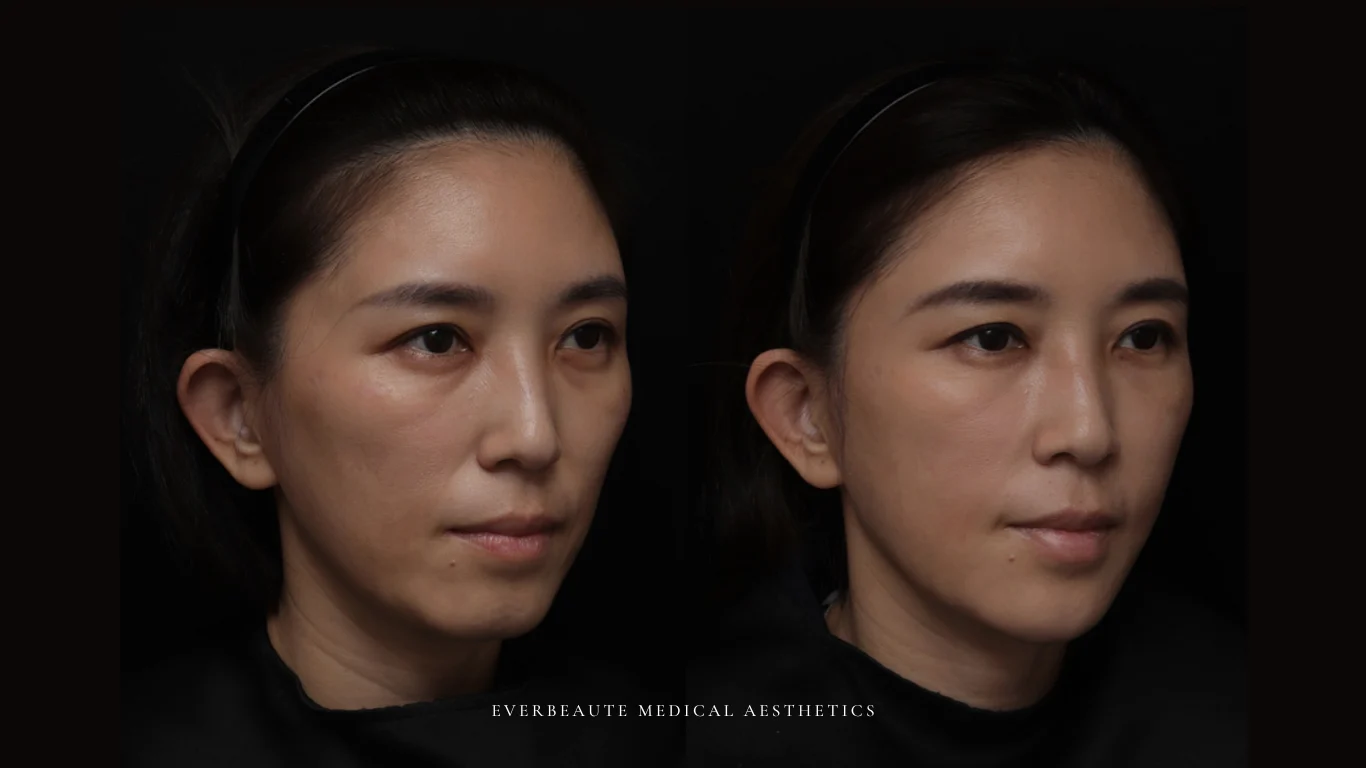 台北醫美推薦 大安區醫美 桃園微整 淚溝 眼袋 黑眼圈 豐唇 木偶紋 凝境美學診所 曾繁聞醫師 于曉恩醫師 皮膚科 專科 專業 效果自然 微整形 填補 填充 瑞士緹奧希 玻尿酸 喬雅登 水無痕 保柔緹 女神動態 熊貓針 淚溝針 童顏針 伊蓮絲 精靈針 喬雅露 逆時針 價格 副作用 後遺症 dcard ptt 成功案例 玻尿酸豐唇前後對比 豐唇、玻尿酸豐唇、自然豐唇、唇形改善、唇線重塑、唇峰設計、唇部微整形、豐唇注射推薦、自然飽滿唇、唇部玻尿酸 17