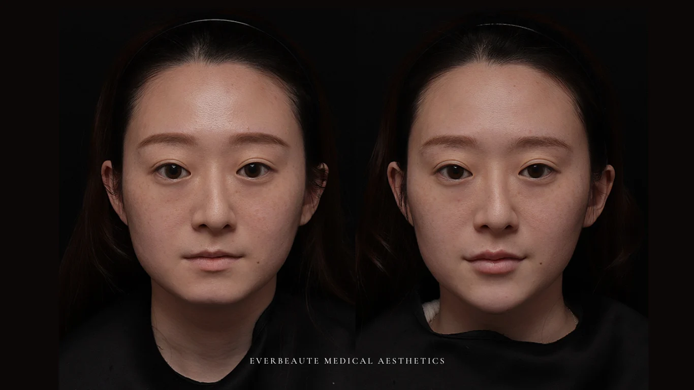 台北醫美推薦 大安區醫美 桃園微整 淚溝 眼袋 黑眼圈 豐唇 木偶紋 凝境美學診所 曾繁聞醫師 于曉恩醫師 皮膚科 專科 專業 效果自然 微整形 填補 填充 瑞士緹奧希 玻尿酸 喬雅登 水無痕 保柔緹 女神動態 熊貓針 淚溝針 童顏針 伊蓮絲 精靈針 喬雅露 逆時針 價格 副作用 後遺症 dcard ptt 成功案例 玻尿酸豐唇前後對比 豐唇、玻尿酸豐唇、自然豐唇、唇形改善、唇線重塑、唇峰設計、唇部微整形、豐唇注射推薦、自然飽滿唇、唇部玻尿酸