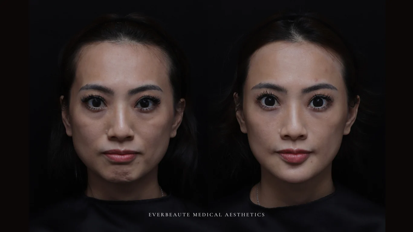 台北醫美推薦 大安區醫美 桃園微整 淚溝 眼袋 黑眼圈 豐唇 木偶紋 凝境美學診所 曾繁聞醫師 于曉恩醫師 皮膚科 專科 專業 效果自然 微整形 填補 填充 瑞士緹奧希 玻尿酸 喬雅登 水無痕 保柔緹 女神動態 熊貓針 淚溝針 童顏針 伊蓮絲 精靈針 喬雅露 逆時針 價格 副作用 後遺症 dcard ptt 成功案例 玻尿酸豐唇前後對比 豐唇、玻尿酸豐唇、自然豐唇、唇形改善、唇線重塑、唇峰設計、唇部微整形、豐唇注射推薦、自然飽滿唇、唇部玻尿酸 18