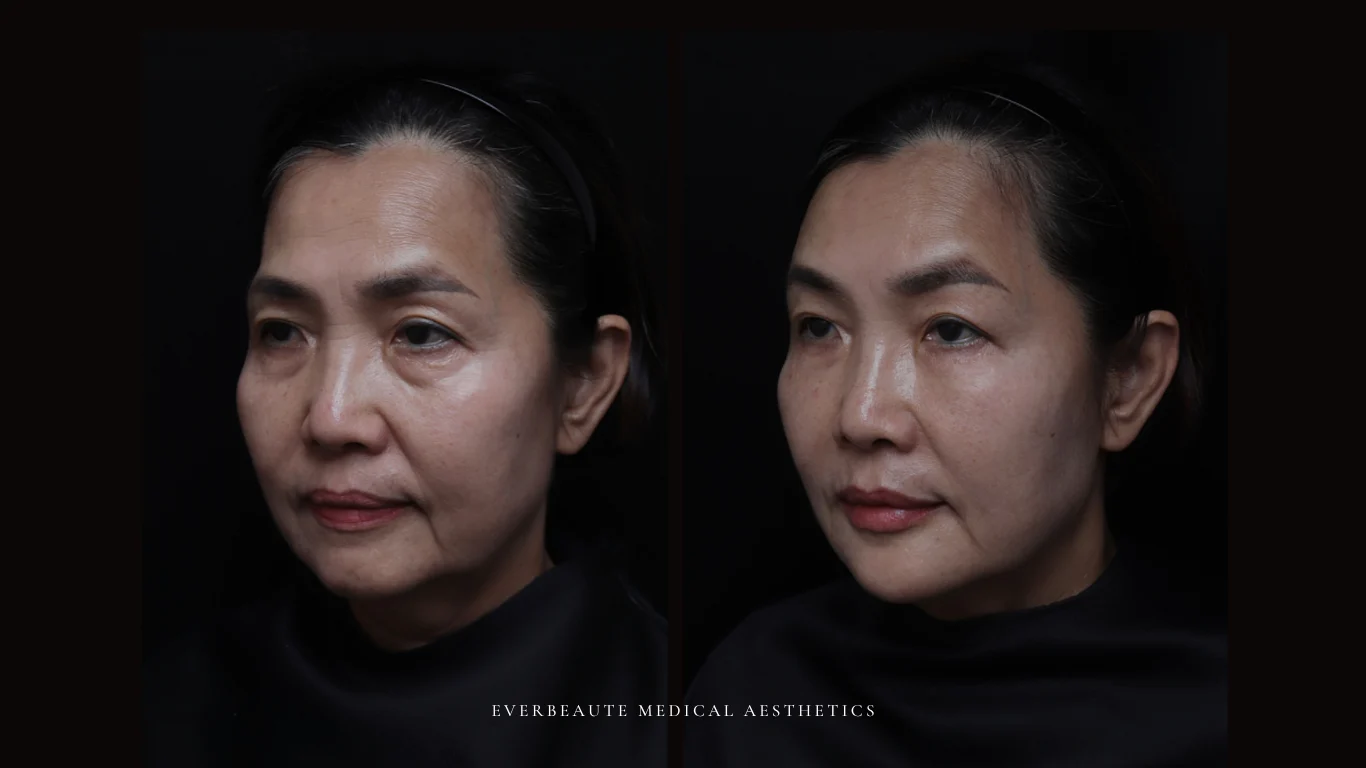 台北醫美推薦 大安區醫美 桃園微整 淚溝 眼袋 黑眼圈 豐唇 木偶紋 凝境美學診所 曾繁聞醫師 于曉恩醫師 皮膚科 專科 專業 效果自然 微整形 填補 填充 瑞士緹奧希 玻尿酸 喬雅登 水無痕 保柔緹 女神動態 熊貓針 淚溝針 童顏針 伊蓮絲 精靈針 喬雅露 逆時針 價格 副作用 後遺症 dcard ptt 成功案例 玻尿酸豐唇前後對比 豐唇、玻尿酸豐唇、自然豐唇、唇形改善、唇線重塑、唇峰設計、唇部微整形、豐唇注射推薦、自然飽滿唇、唇部玻尿酸 22