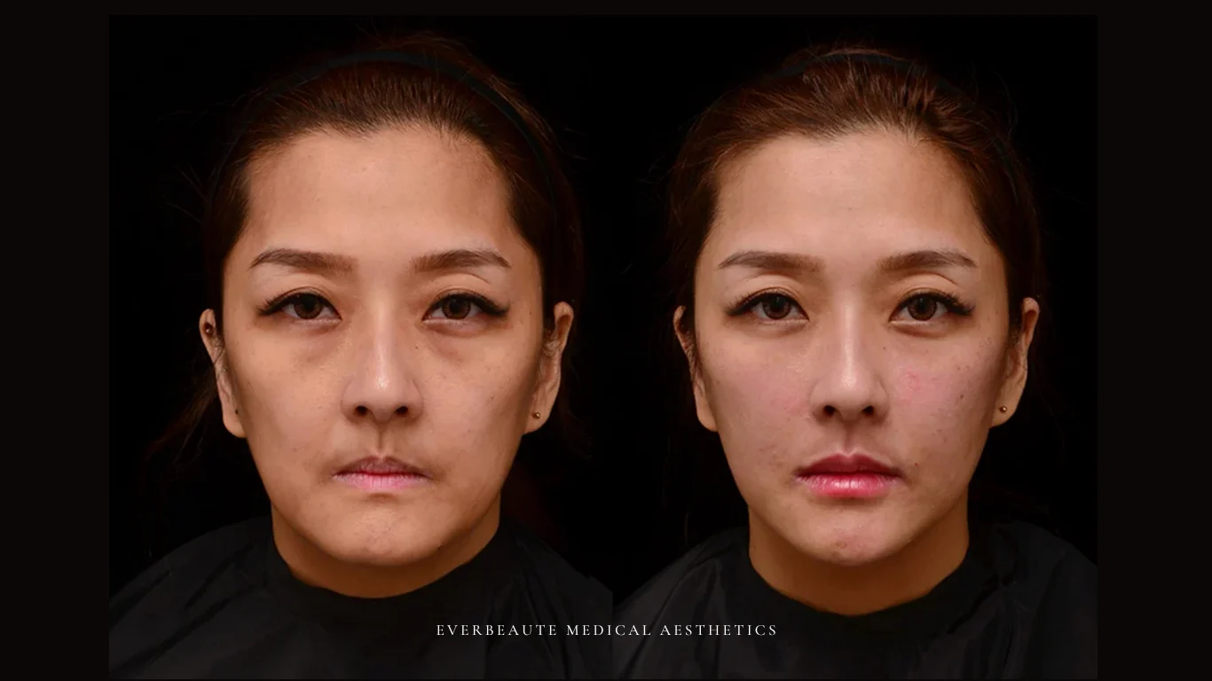 台北醫美推薦 大安區醫美 桃園微整 淚溝 眼袋 黑眼圈 豐唇 木偶紋 凝境美學診所 曾繁聞醫師 于曉恩醫師 皮膚科 專科 專業 效果自然 微整形 填補 填充 瑞士緹奧希 玻尿酸 喬雅登 水無痕 保柔緹 女神動態 熊貓針 淚溝針 童顏針 伊蓮絲 精靈針 喬雅露 逆時針 價格 副作用 後遺症 dcard ptt 成功案例 玻尿酸豐唇前後對比 豐唇、玻尿酸豐唇、自然豐唇、唇形改善、唇線重塑、唇峰設計、唇部微整形、豐唇注射推薦、自然飽滿唇、唇部玻尿酸 20 凝境美學診所院長醫師擔任精靈針Aesthefill艾麗斯原廠國際級講師 示範注射教學案例 豐唇、太陽穴、臉頰凹陷、淚溝、蘋果肌