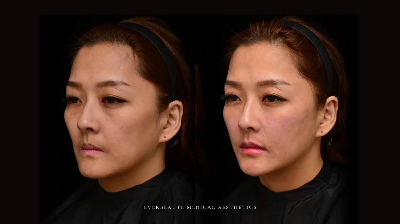 台北醫美推薦 大安區醫美 桃園微整 淚溝 眼袋 黑眼圈 豐唇 木偶紋 凝境美學診所 曾繁聞醫師 于曉恩醫師 皮膚科 專科 專業 效果自然 微整形 填補 填充 瑞士緹奧希 玻尿酸 喬雅登 水無痕 保柔緹 女神動態 熊貓針 淚溝針 童顏針 伊蓮絲 精靈針 喬雅露 逆時針 價格 副作用 後遺症 dcard ptt 成功案例 玻尿酸豐唇前後對比 豐唇、玻尿酸豐唇、自然豐唇、唇形改善、唇線重塑、唇峰設計、唇部微整形、豐唇注射推薦、自然飽滿唇、唇部玻尿酸 20 凝境美學診所院長醫師擔任精靈針Aesthefill艾麗斯原廠國際級講師 示範注射教學案例 豐唇、太陽穴、臉頰凹陷、淚溝、蘋果肌