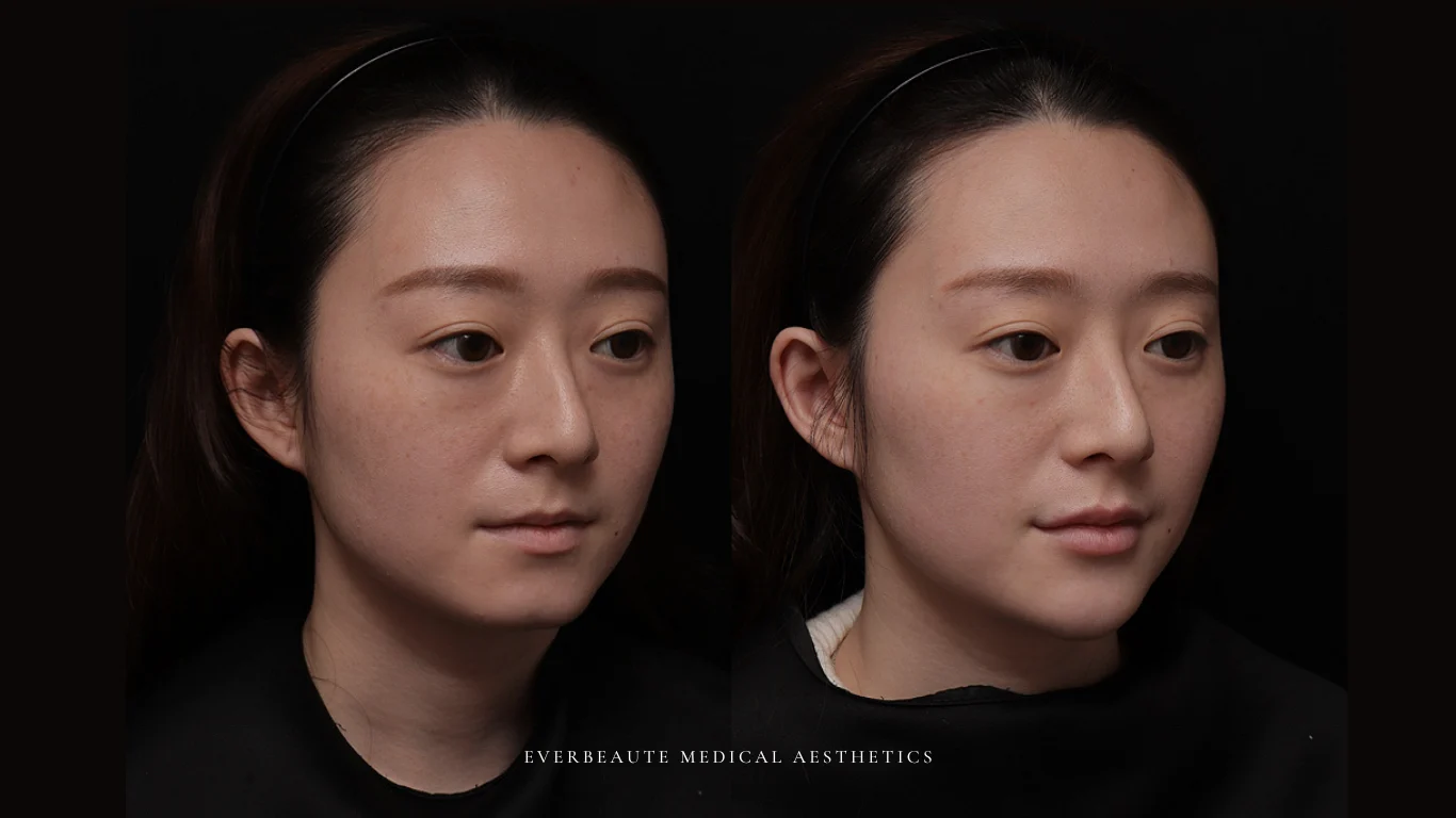 台北醫美推薦 大安區醫美 桃園微整 淚溝 眼袋 黑眼圈 豐唇 木偶紋 凝境美學診所 曾繁聞醫師 于曉恩醫師 皮膚科 專科 專業 效果自然 微整形 填補 填充 瑞士緹奧希 玻尿酸 喬雅登 水無痕 保柔緹 女神動態 熊貓針 淚溝針 童顏針 伊蓮絲 精靈針 喬雅露 逆時針 價格 副作用 後遺症 dcard ptt 成功案例 玻尿酸豐唇前後對比 豐唇、玻尿酸豐唇、自然豐唇、唇形改善、唇線重塑、唇峰設計、唇部微整形、豐唇注射推薦、自然飽滿唇、唇部玻尿酸 2