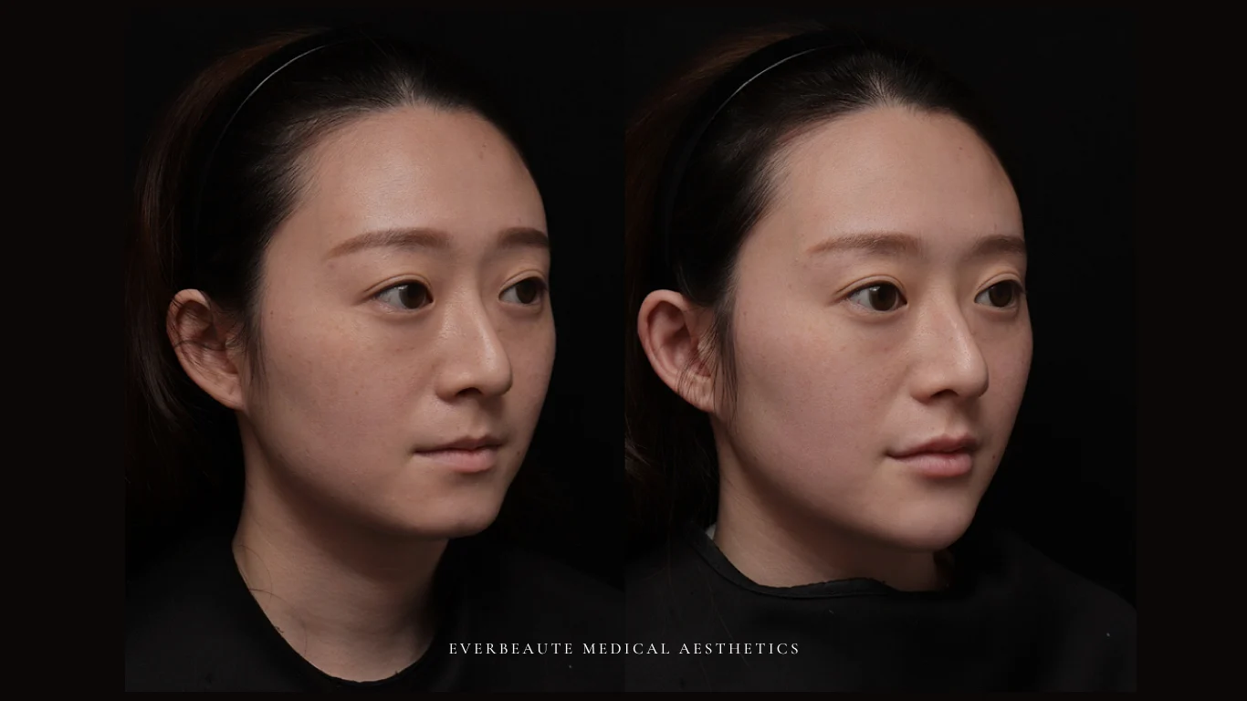 台北醫美推薦 大安區醫美 桃園微整 淚溝 眼袋 黑眼圈 豐唇 木偶紋 凝境美學診所 曾繁聞醫師 于曉恩醫師 皮膚科 專科 專業 效果自然 微整形 填補 填充 瑞士緹奧希 玻尿酸 喬雅登 水無痕 保柔緹 女神動態 熊貓針 淚溝針 童顏針 伊蓮絲 精靈針 喬雅露 逆時針 價格 副作用 後遺症 dcard ptt 成功案例 玻尿酸豐唇前後對比 豐唇、玻尿酸豐唇、自然豐唇、唇形改善、唇線重塑、唇峰設計、唇部微整形、豐唇注射推薦、自然飽滿唇、唇部玻尿酸 4