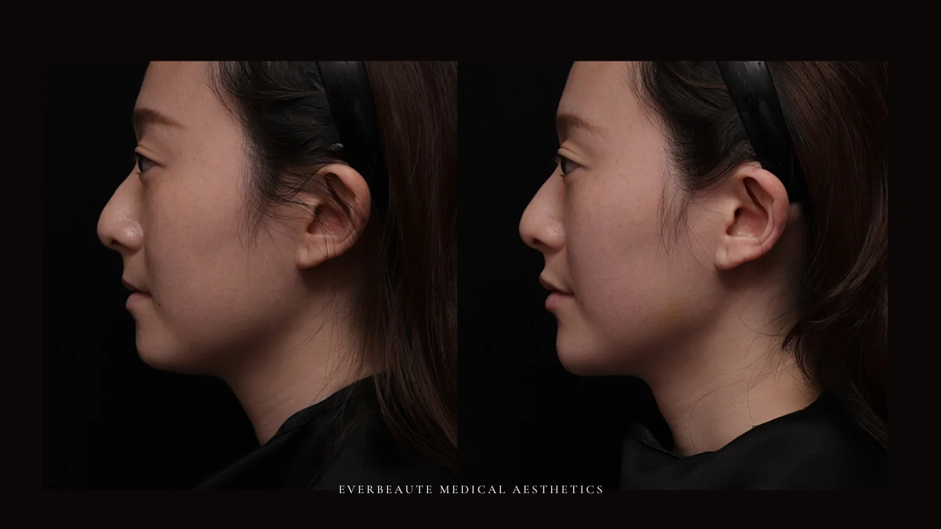 台北醫美推薦 大安區醫美 桃園微整 淚溝 眼袋 黑眼圈 豐唇 木偶紋 凝境美學診所 曾繁聞醫師 于曉恩醫師 皮膚科 專科 專業 效果自然 微整形 填補 填充 瑞士緹奧希 玻尿酸 喬雅登 水無痕 保柔緹 女神動態 熊貓針 淚溝針 童顏針 伊蓮絲 精靈針 喬雅露 逆時針 價格 副作用 後遺症 dcard ptt 成功案例 玻尿酸豐唇前後對比 豐唇、玻尿酸豐唇、自然豐唇、唇形改善、唇線重塑、唇峰設計、唇部微整形、豐唇注射推薦、自然飽滿唇、唇部玻尿酸 5