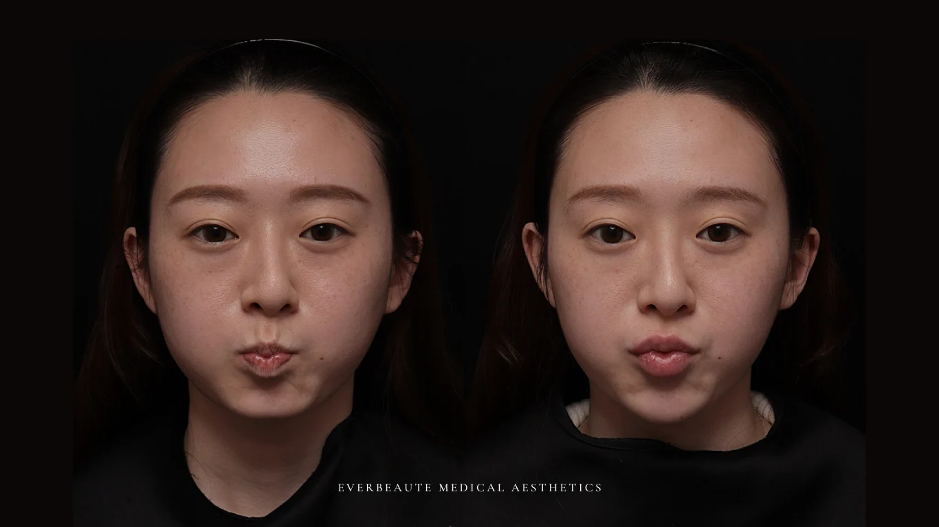 台北醫美推薦 大安區醫美 桃園微整 淚溝 眼袋 黑眼圈 豐唇 木偶紋 凝境美學診所 曾繁聞醫師 于曉恩醫師 皮膚科 專科 專業 效果自然 微整形 填補 填充 瑞士緹奧希 玻尿酸 喬雅登 水無痕 保柔緹 女神動態 熊貓針 淚溝針 童顏針 伊蓮絲 精靈針 喬雅露 逆時針 價格 副作用 後遺症 dcard ptt 成功案例 玻尿酸豐唇前後對比 豐唇、玻尿酸豐唇、自然豐唇、唇形改善、唇線重塑、唇峰設計、唇部微整形、豐唇注射推薦、自然飽滿唇、唇部玻尿酸 6