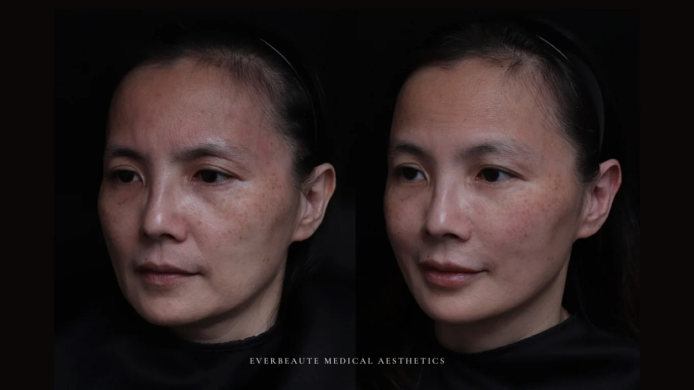 台北醫美推薦 大安區醫美 桃園微整 淚溝 眼袋 黑眼圈 豐唇 木偶紋 凝境美學診所 曾繁聞醫師 于曉恩醫師 皮膚科 專科 專業 效果自然 微整形 填補 填充 瑞士緹奧希 玻尿酸 喬雅登 水無痕 保柔緹 女神動態 熊貓針 淚溝針 童顏針 伊蓮絲 精靈針 喬雅露 逆時針 價格 副作用 後遺症 dcard ptt 成功案例 玻尿酸豐唇前後對比 豐唇、玻尿酸豐唇、自然豐唇、唇形改善、唇線重塑、唇峰設計、唇部微整形、豐唇注射推薦、自然飽滿唇、唇部玻尿酸 7