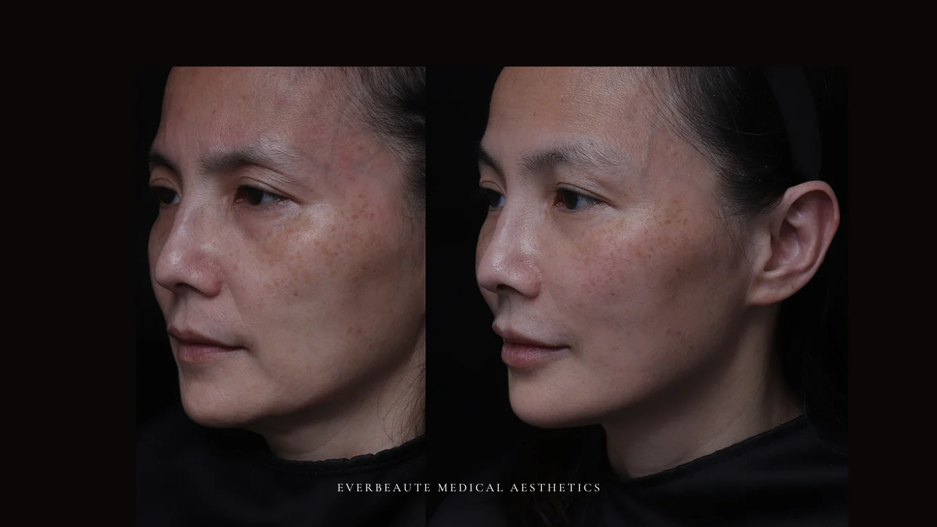 台北醫美推薦 大安區醫美 桃園微整 淚溝 眼袋 黑眼圈 豐唇 木偶紋 凝境美學診所 曾繁聞醫師 于曉恩醫師 皮膚科 專科 專業 效果自然 微整形 填補 填充 瑞士緹奧希 玻尿酸 喬雅登 水無痕 保柔緹 女神動態 熊貓針 淚溝針 童顏針 伊蓮絲 精靈針 喬雅露 逆時針 價格 副作用 後遺症 dcard ptt 成功案例 玻尿酸豐唇前後對比 豐唇、玻尿酸豐唇、自然豐唇、唇形改善、唇線重塑、唇峰設計、唇部微整形、豐唇注射推薦、自然飽滿唇、唇部玻尿酸 8