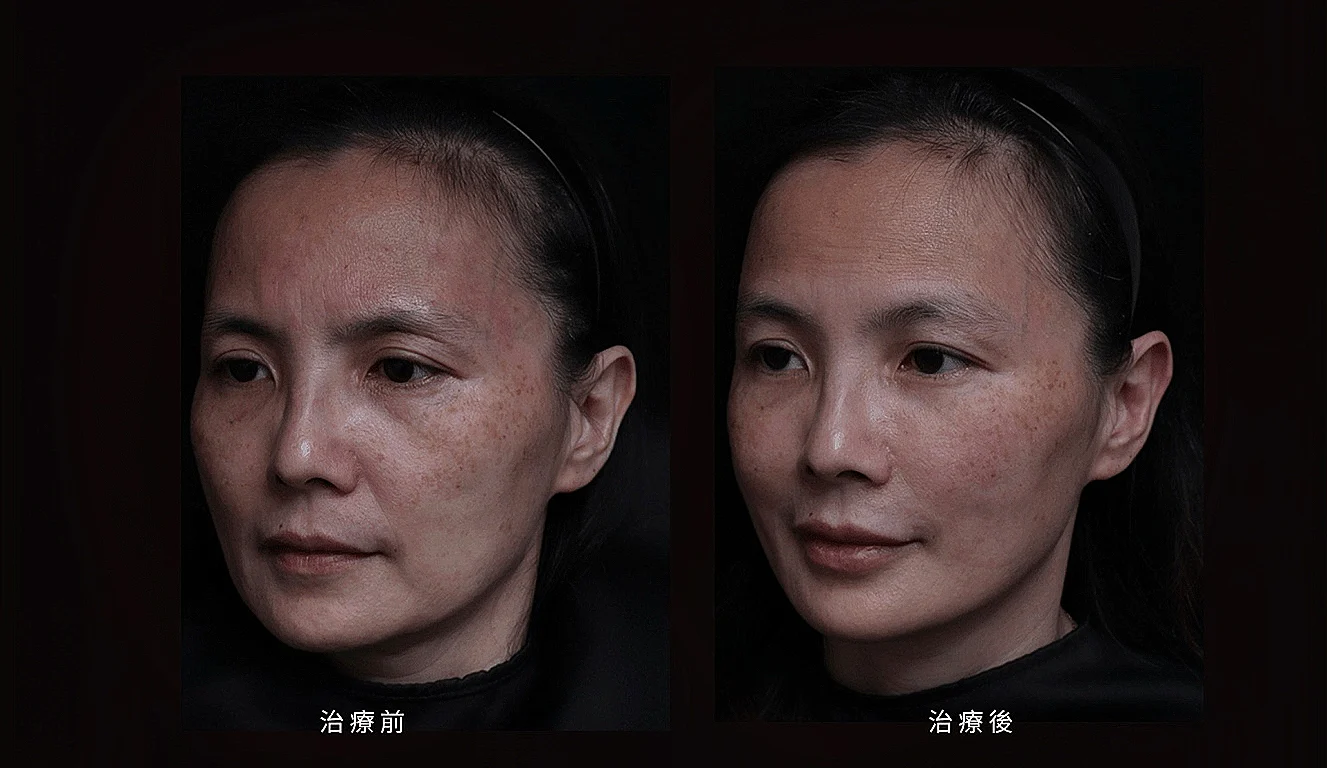 木偶紋 法令紋 三八紋 凝境美學診所 于曉恩 曾繁聞 鼻基底凹陷 02