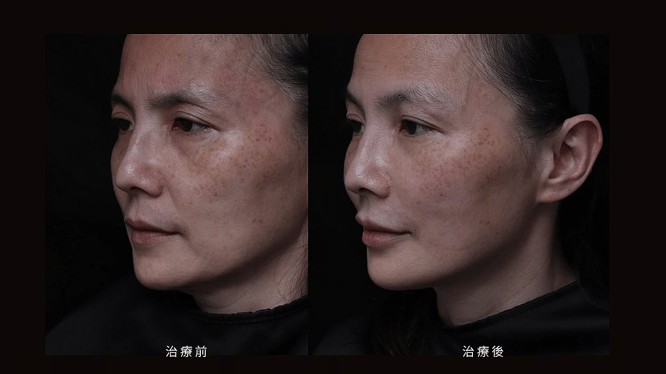 木偶紋 法令紋 三八紋 凝境美學診所 于曉恩 曾繁聞 鼻基底凹陷 05