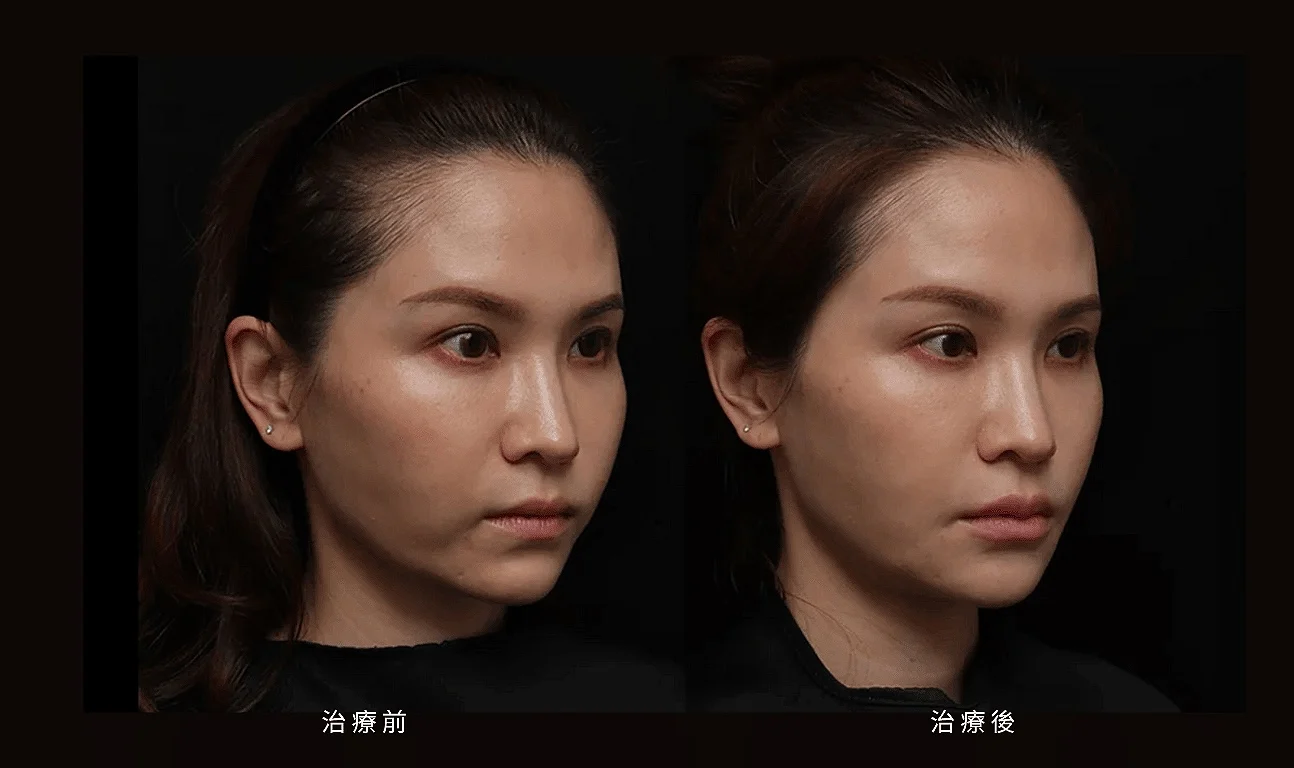 木偶紋 法令紋 三八紋 凝境美學診所 于曉恩 曾繁聞 鼻基底凹陷 07