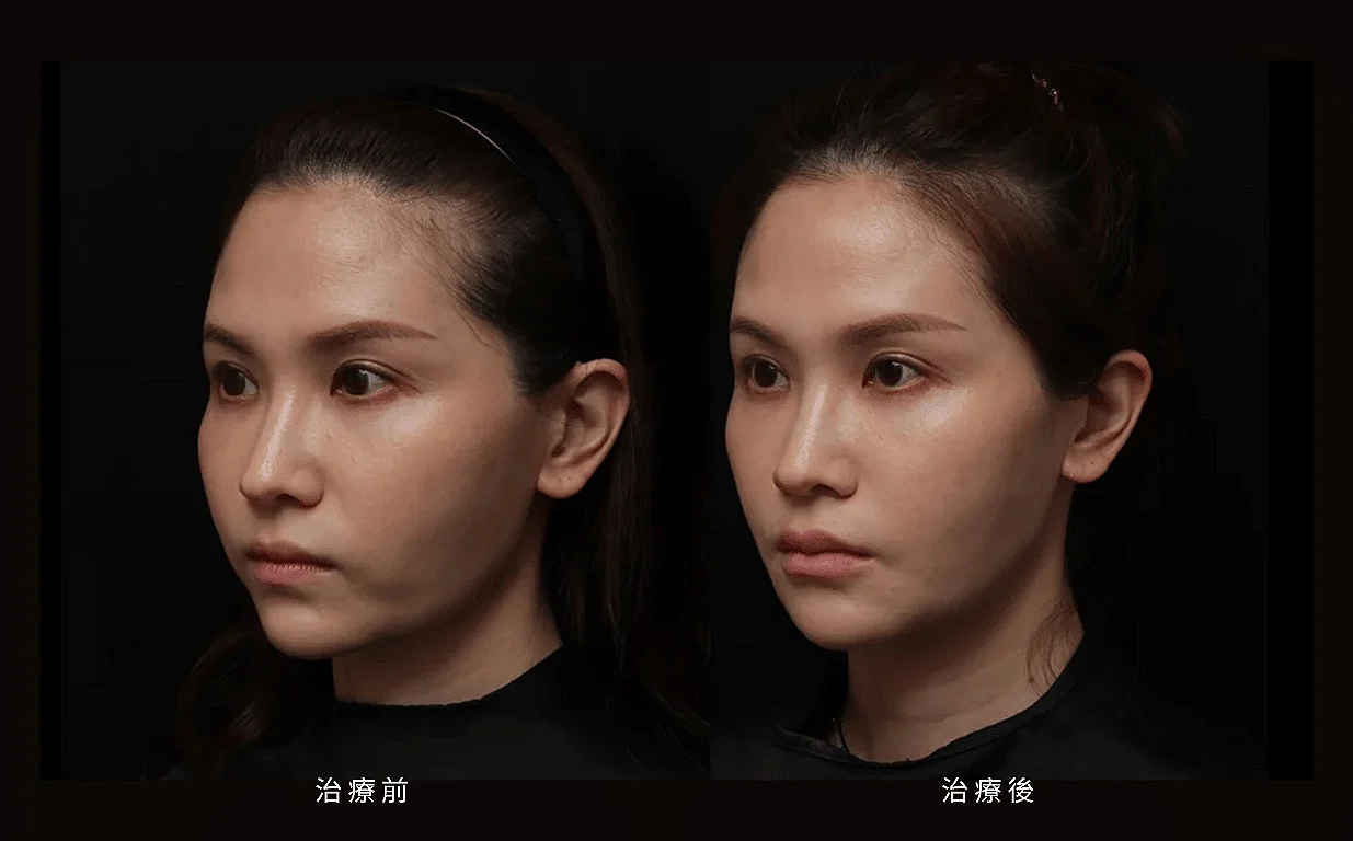 木偶紋 法令紋 三八紋 凝境美學診所 于曉恩 曾繁聞 鼻基底凹陷 08