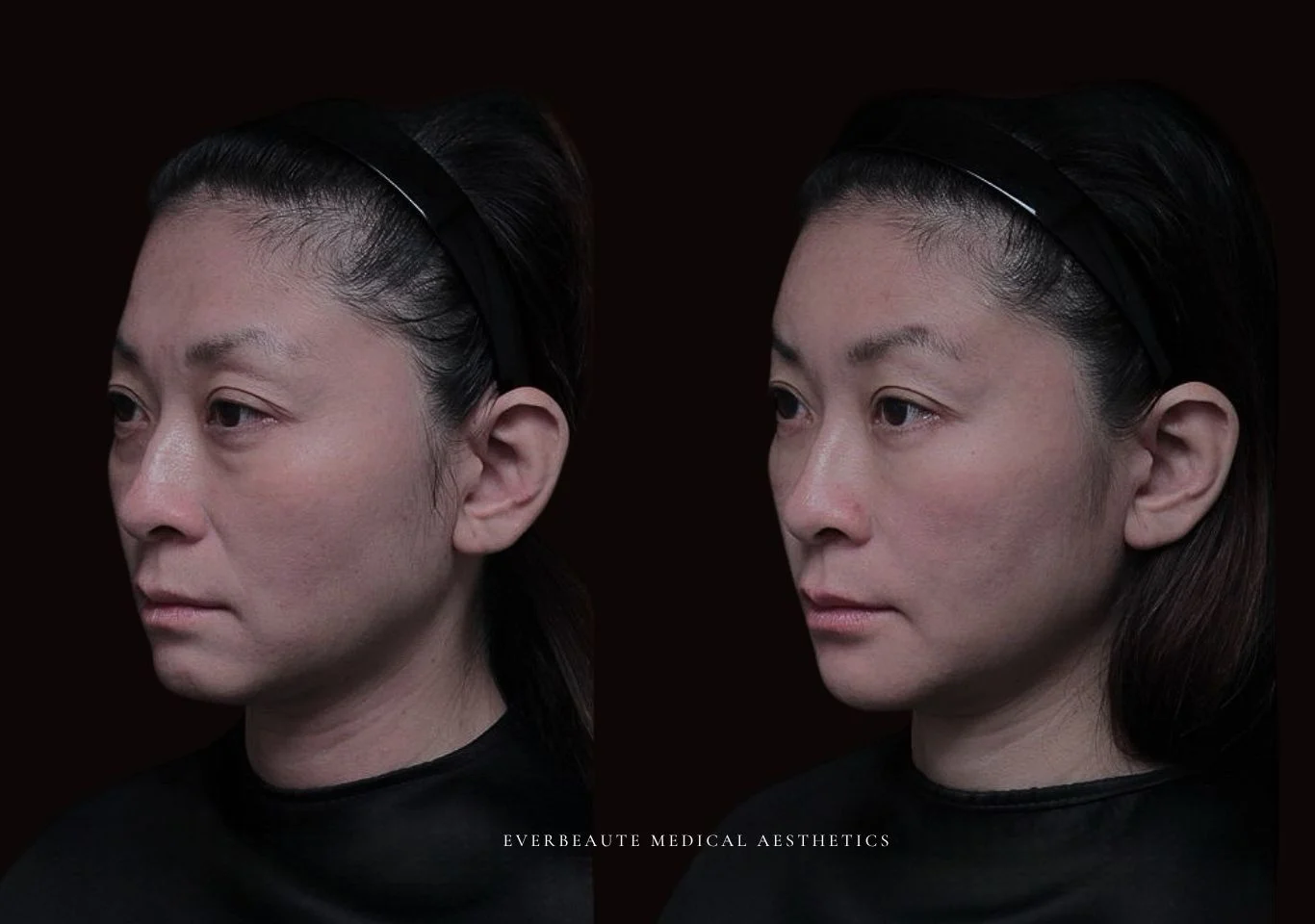 台北醫美推薦 大安區醫美 桃園微整 淚溝 眼袋 黑眼圈 豐唇 木偶紋 凝境美學診所 曾繁聞醫師 于曉恩醫師 皮膚科 專科 專業 效果自然 微整形 填補 填充 瑞士緹奧希 玻尿酸 喬雅登 水無痕 保柔緹 女神動態 熊貓針 淚溝針 童顏針 伊蓮絲 精靈針 喬雅露 逆時針 價格 副作用 後遺症 dcard ptt 成功案例 玻尿酸豐唇前後對比 豐唇、玻尿酸豐唇、自然豐唇、唇形改善、唇線重塑、唇峰設計、唇部微整形、豐唇注射推薦、自然飽滿唇、唇部玻尿酸 大安站醫美診所 豐額 額頭塑形 豐額填充 飽滿天庭 1