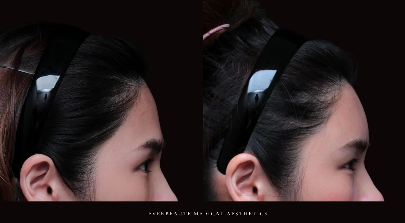 台北醫美推薦 大安區醫美 桃園微整 淚溝 眼袋 黑眼圈 豐唇 木偶紋 凝境美學診所 曾繁聞醫師 于曉恩醫師 皮膚科 專科 專業 效果自然 微整形 填補 填充 瑞士緹奧希 玻尿酸 喬雅登 水無痕 保柔緹 女神動態 熊貓針 淚溝針 童顏針 伊蓮絲 精靈針 喬雅露 逆時針 價格 副作用 後遺症 dcard ptt 成功案例 玻尿酸豐唇前後對比 豐唇、玻尿酸豐唇、自然豐唇、唇形改善、唇線重塑、唇峰設計、唇部微整形、豐唇注射推薦、自然飽滿唇、唇部玻尿酸 大安站醫美診所 豐額 額頭塑形 豐額填充 飽滿天庭 額頭飽滿 喬雅登玻尿酸 66