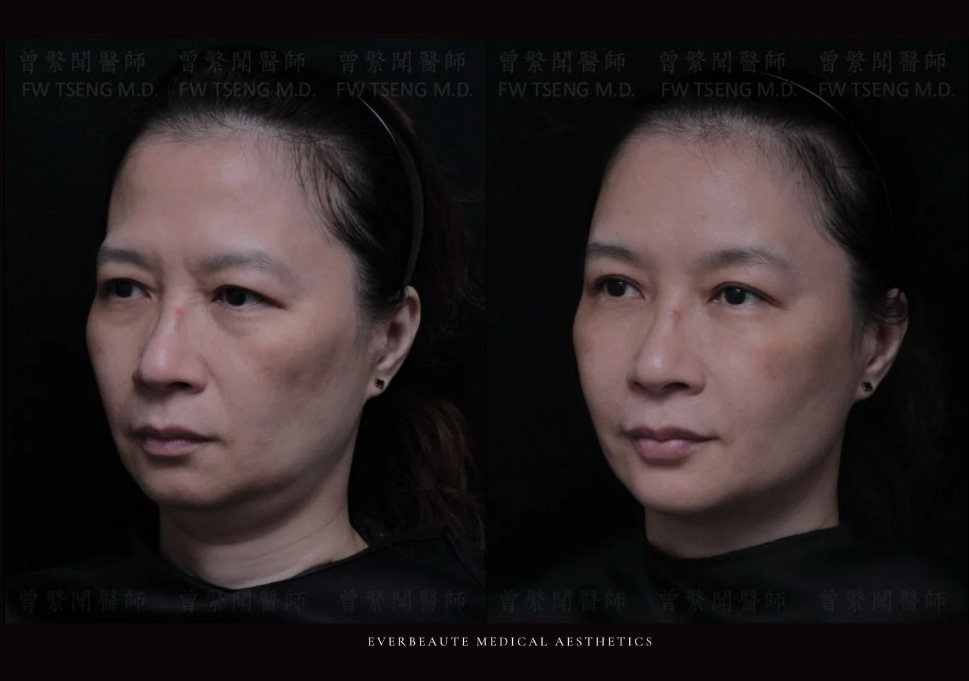 台北醫美推薦 大安區醫美 桃園微整 淚溝 眼袋 黑眼圈 豐唇 木偶紋 凝境美學診所 曾繁聞醫師 于曉恩醫師 皮膚科 專科 專業 效果自然 微整形 填補 填充 瑞士緹奧希 玻尿酸 喬雅登 水無痕 保柔緹 女神動態 熊貓針 淚溝針 童顏針 伊蓮絲 精靈針 喬雅露 逆時針 價格 副作用 後遺症 dcard ptt 成功案例 玻尿酸豐唇前後對比 豐唇、玻尿酸豐唇、自然豐唇、唇形改善、唇線重塑、唇峰設計、唇部微整形、豐唇注射推薦、自然飽滿唇、唇部玻尿酸 大安站醫美診所 豐額 額頭塑形 豐額填充 飽滿天庭 額頭飽滿5