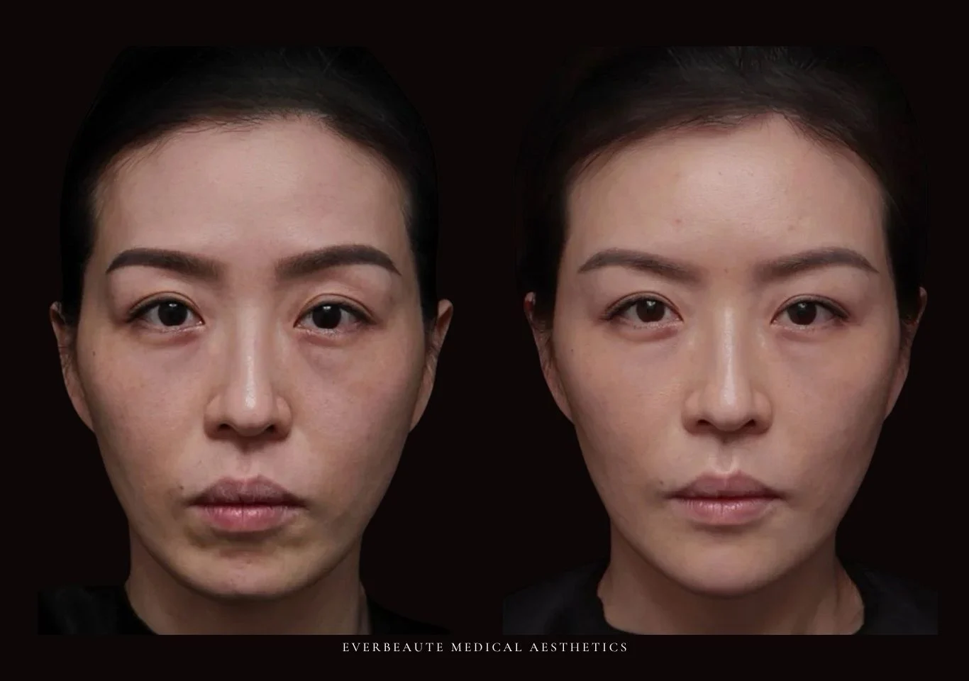 台北醫美推薦 大安區醫美 桃園微整 淚溝 眼袋 黑眼圈 豐唇 木偶紋 凝境美學診所 曾繁聞醫師 于曉恩醫師 皮膚科 專科 專業 效果自然 微整形 填補 填充 瑞士緹奧希 玻尿酸 喬雅登 水無痕 保柔緹 女神動態 熊貓針 淚溝針 童顏針 伊蓮絲 精靈針 喬雅露 逆時針 價格 副作用 後遺症 dcard ptt 成功案例 玻尿酸豐唇前後對比 豐唇、玻尿酸豐唇、自然豐唇、唇形改善、唇線重塑、唇峰設計、唇部微整形、豐唇注射推薦、自然飽滿唇、唇部玻尿酸 大安站醫美診所 豐額 額頭塑形 豐額填充 飽滿天庭 額頭飽滿