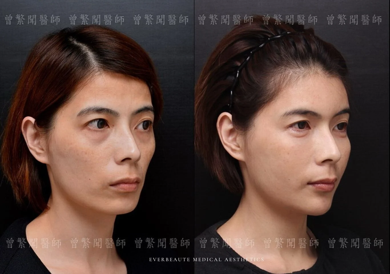 台北醫美推薦 大安區醫美 桃園微整 淚溝 眼袋 黑眼圈 豐唇 木偶紋 凝境美學診所 曾繁聞醫師 于曉恩醫師 皮膚科 專科 專業 效果自然 微整形 填補 填充 瑞士緹奧希 玻尿酸 喬雅登 水無痕 保柔緹 女神動態 熊貓針 淚溝針 童顏針 伊蓮絲 精靈針 喬雅露 逆時針 價格 副作用 後遺症 dcard ptt 成功案例 玻尿酸豐唇前後對比 豐唇、玻尿酸豐唇、自然豐唇、唇形改善、唇線重塑、唇峰設計、唇部微整形、豐唇注射推薦、自然飽滿唇、唇部玻尿酸 大安站醫美診所 豐額 額頭塑形 豐額填充 飽滿天庭 額頭飽滿 喬雅登玻尿酸 1