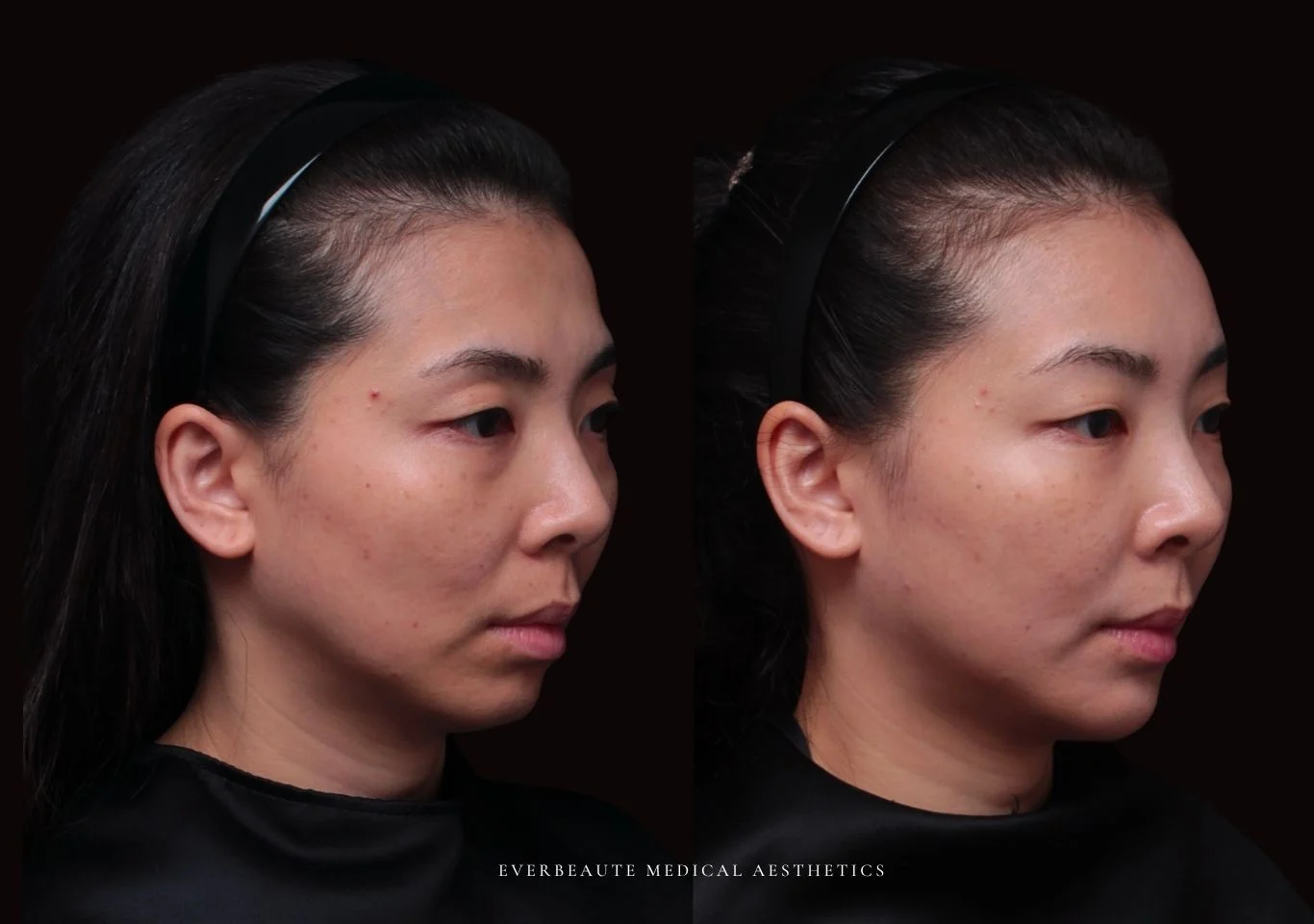 台北醫美推薦 大安區醫美 桃園微整 淚溝 眼袋 黑眼圈 豐唇 木偶紋 凝境美學診所 曾繁聞醫師 于曉恩醫師 皮膚科 專科 專業 效果自然 微整形 填補 填充 瑞士緹奧希 玻尿酸 喬雅登 水無痕 保柔緹 女神動態 熊貓針 淚溝針 童顏針 伊蓮絲 精靈針 喬雅露 逆時針 價格 副作用 後遺症 dcard ptt 成功案例 玻尿酸豐唇前後對比 豐唇、玻尿酸豐唇、自然豐唇、唇形改善、唇線重塑、唇峰設計、唇部微整形、豐唇注射推薦、自然飽滿唇、唇部玻尿酸 大安站醫美診所 豐額 額頭塑形 豐額填充 飽滿天庭 額頭飽滿666