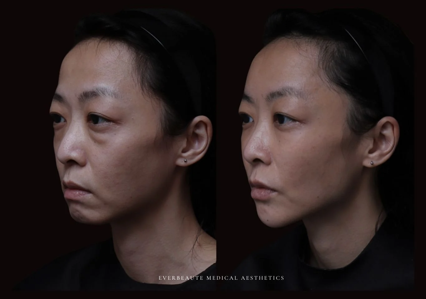 台北醫美推薦 大安區醫美 桃園微整 淚溝 眼袋 黑眼圈 木偶紋 蘋果肌 印地安紋 貓咪紋 嘴邊肉下垂 非手術 無痕拉提 凝境美學診所 曾繁聞醫師 于曉恩醫師 皮膚科 專科 專業 效果自然 微整形 填補 填充 瑞士緹奧希 玻尿酸 喬雅登 水無痕 保柔緹 女神動態 熊貓針 淚溝針 童顏針 伊蓮絲 精靈針 喬雅露 逆時針 價格 副作用 後遺症 dcard ptt 成功案例 大安站醫美