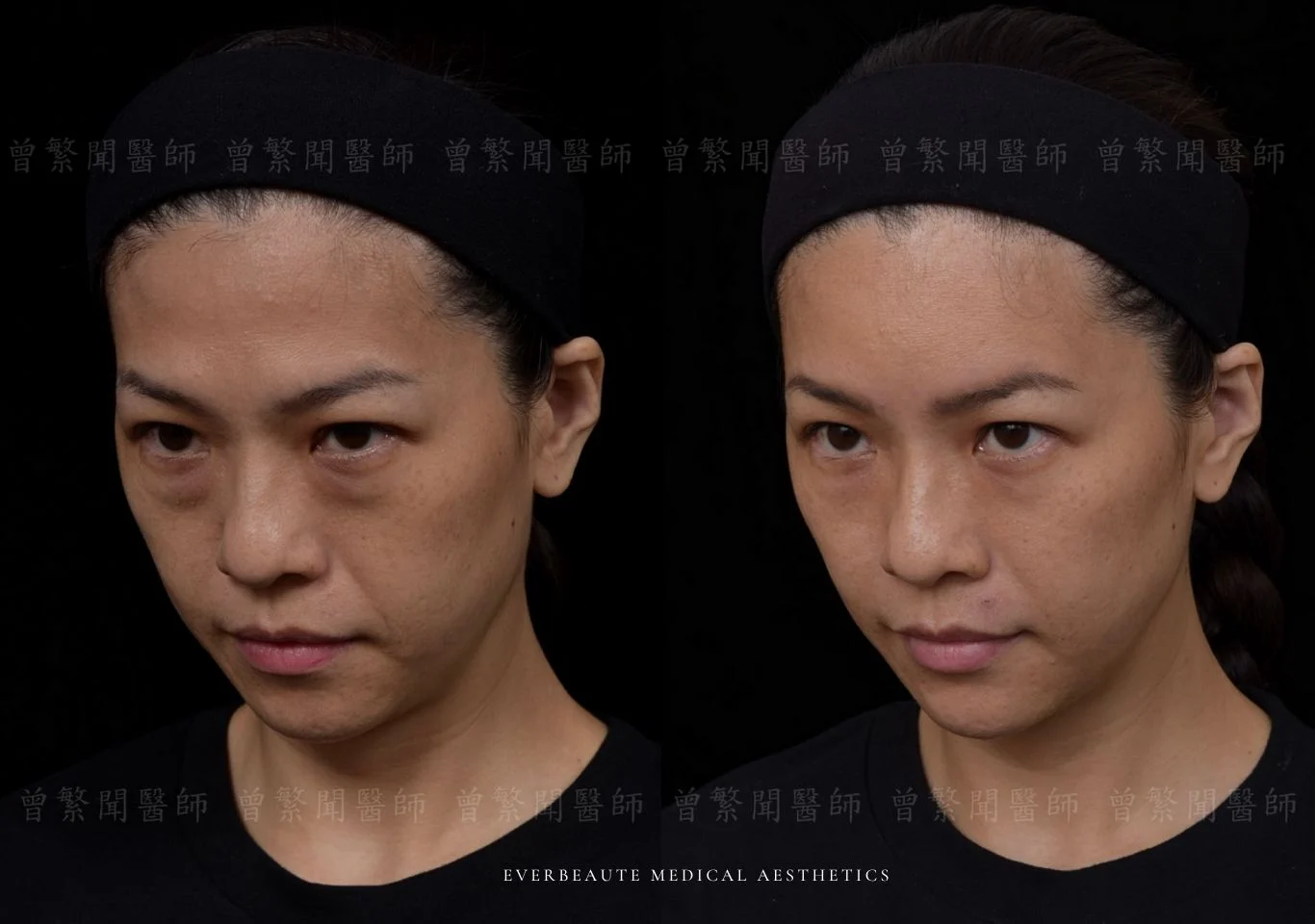 台北醫美推薦 大安區醫美 桃園微整 淚溝 眼袋 黑眼圈 豐唇 木偶紋 凝境美學診所 曾繁聞醫師 于曉恩醫師 皮膚科 專科 專業 效果自然 微整形 填補 填充 瑞士緹奧希 玻尿酸 喬雅登 水無痕 保柔緹 女神動態 熊貓針 淚溝針 童顏針 伊蓮絲 精靈針 喬雅露 逆時針 價格 副作用 後遺症 dcard ptt 成功案例 玻尿酸豐唇前後對比 豐唇、玻尿酸豐唇、自然豐唇、唇形改善、唇線重塑、唇峰設計、唇部微整形、豐唇注射推薦、自然飽滿唇、唇部玻尿酸 大安站醫美診所 豐額 額頭塑形 豐額填充 飽滿天庭 額頭飽滿 喬雅登