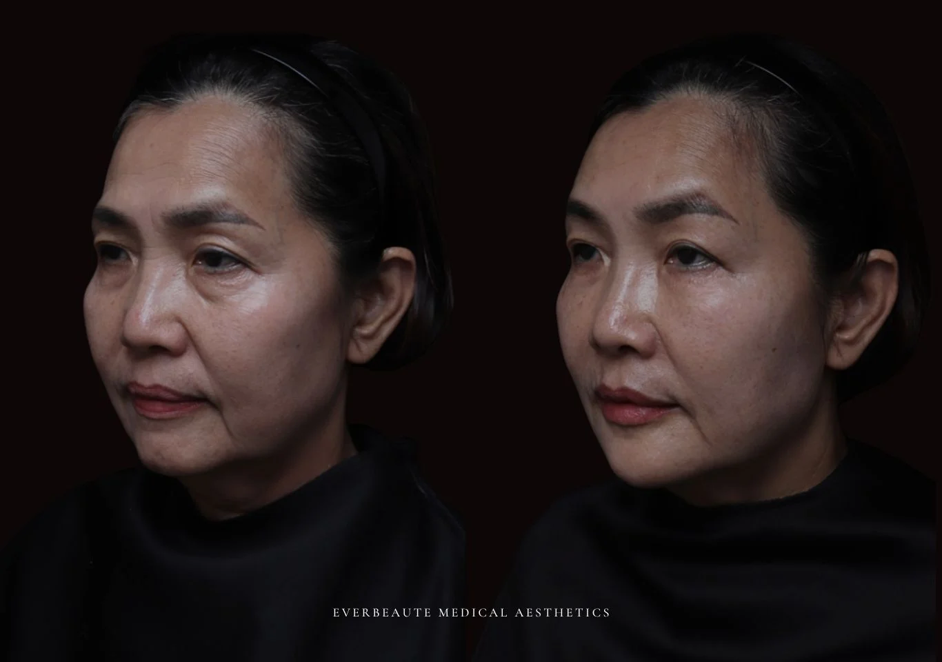 台北醫美推薦 大安區醫美 桃園微整 淚溝 眼袋 黑眼圈 木偶紋 蘋果肌 印地安紋 貓咪紋 嘴邊肉下垂 非手術 無痕拉提 凝境美學診所 曾繁聞醫師 于曉恩醫師 皮膚科 專科 專業 效果自然 微整形 填補 填充 瑞士緹奧希 玻尿酸 喬雅登 水無痕 保柔緹 女神動態 熊貓針 淚溝針 童顏針 伊蓮絲 精靈針 喬雅露 逆時針 價格 副作用 後遺症 dcard ptt 成功案例 細紋皺紋 大安站 台北醫美診所 台北微整