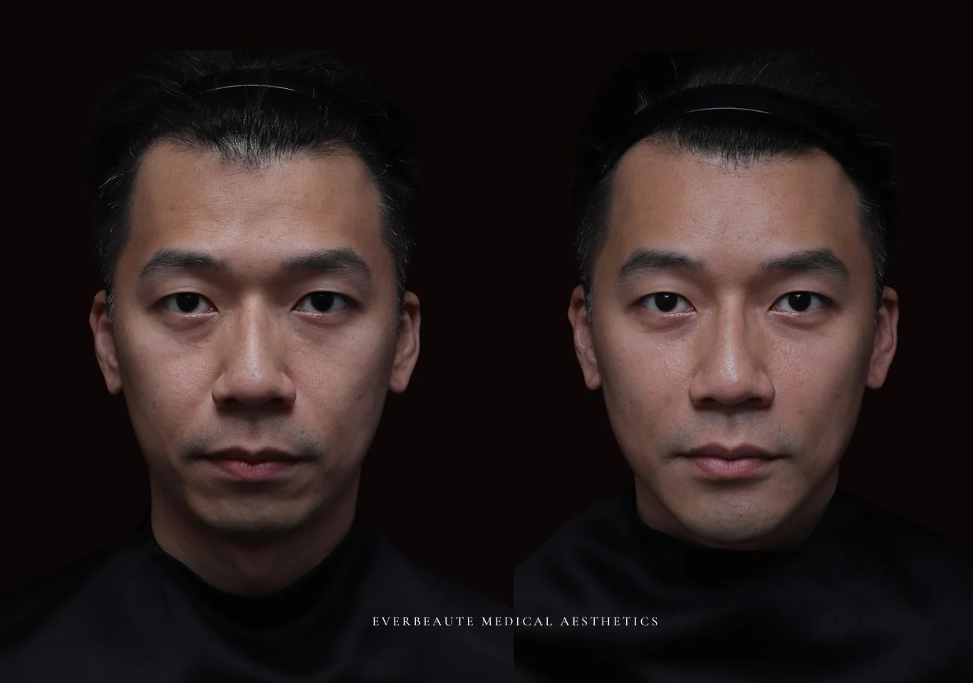 台北醫美推薦 大安區醫美 桃園微整 男性醫美 男生審美 男人有型 豐額頭 太陽穴填補 夫妻宮凹陷 淚溝 眼袋 黑眼圈 蘋果肌飽滿 法令紋填充 鼻基底凹陷 下巴短 下巴後縮 木偶紋 暴牙 嘴凸 下顎輪廓線 非手術 不動刀 無痕拉提 凝境美學診所 曾繁聞醫師 于曉恩醫師 皮膚科 專科 專業 好評 院長 原廠講師級 效果自然 微整形 填補 填充 瑞士緹奧希 玻尿酸 喬雅登 瑞絲朗 水無痕 保柔緹 女神動態 熊貓針 淚溝針 3D 4D聚左旋乳酸 童顏針 舒顏萃 伊蓮絲 Ellanse 艾麗斯 精靈針 喬雅露 薇貝拉 逆時針 熊貓針 膠原蛋白增生 價格 痛 副作用 後遺症 dcard ptt 成功案例1