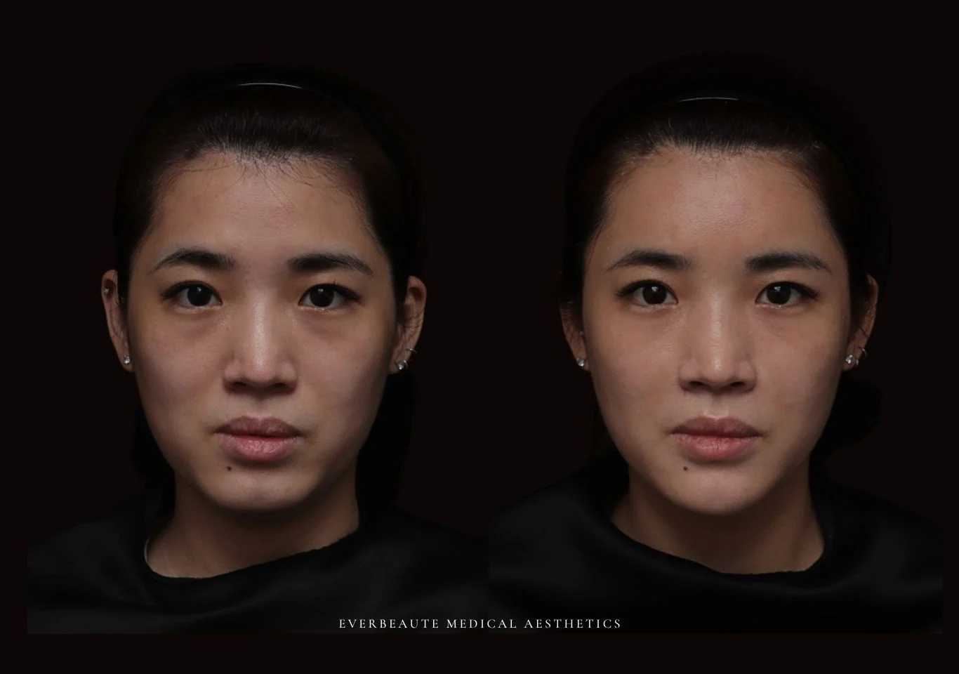 台北醫美推薦 大安區醫美 桃園微整 淚溝 眼袋 黑眼圈 豐唇 木偶紋 凝境美學診所 曾繁聞醫師 于曉恩醫師 皮膚科 專科 專業 效果自然 微整形 填補 填充 瑞士緹奧希 玻尿酸 喬雅登 水無痕 保柔緹 女神動態 熊貓針 淚溝針 童顏針 伊蓮絲 精靈針 喬雅露 逆時針 價格 副作用 後遺症 dcard ptt 成功案例 玻尿酸豐唇前後對比 豐唇、玻尿酸豐唇、自然豐唇、唇形改善、唇線重塑、唇峰設計、唇部微整形、豐唇注射推薦、自然飽滿唇、唇部玻尿酸 大安站醫美