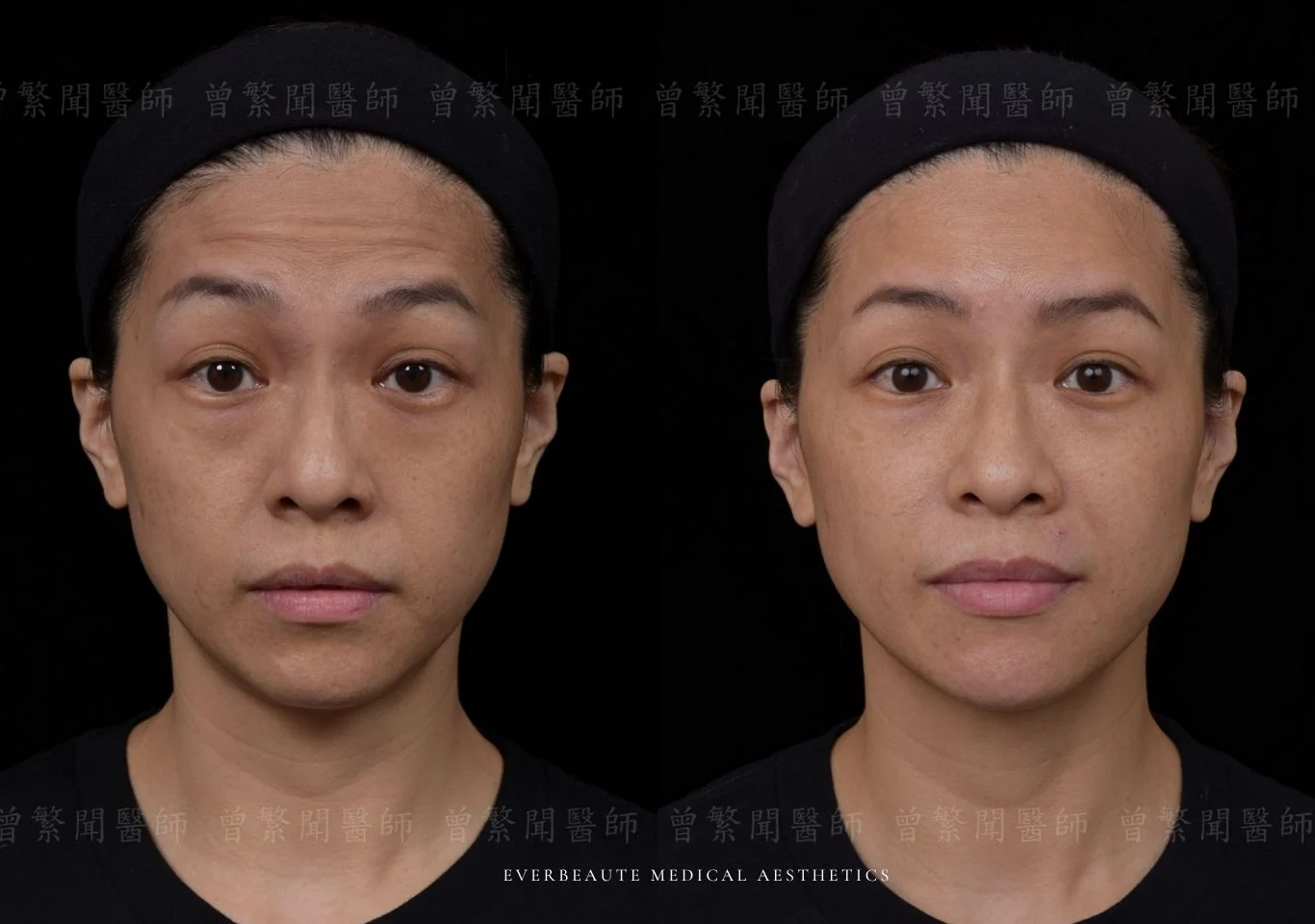 台北醫美推薦 大安區醫美 桃園微整 淚溝 眼袋 黑眼圈 豐唇 木偶紋 凝境美學診所 曾繁聞醫師 于曉恩醫師 皮膚科 專科 專業 效果自然 微整形 填補 填充 瑞士緹奧希 玻尿酸 喬雅登 水無痕 保柔緹 女神動態 熊貓針 淚溝針 童顏針 伊蓮絲 精靈針 喬雅露 逆時針 價格 副作用 後遺症 dcard ptt 成功案例 玻尿酸豐唇前後對比 豐唇、玻尿酸豐唇、自然豐唇、唇形改善、唇線重塑、唇峰設計、唇部微整形、豐唇注射推薦、自然飽滿唇、唇部玻尿酸 大安站醫美診所 豐額 額頭塑形 豐額填充 飽滿天庭 額頭飽滿 喬雅登玻尿酸