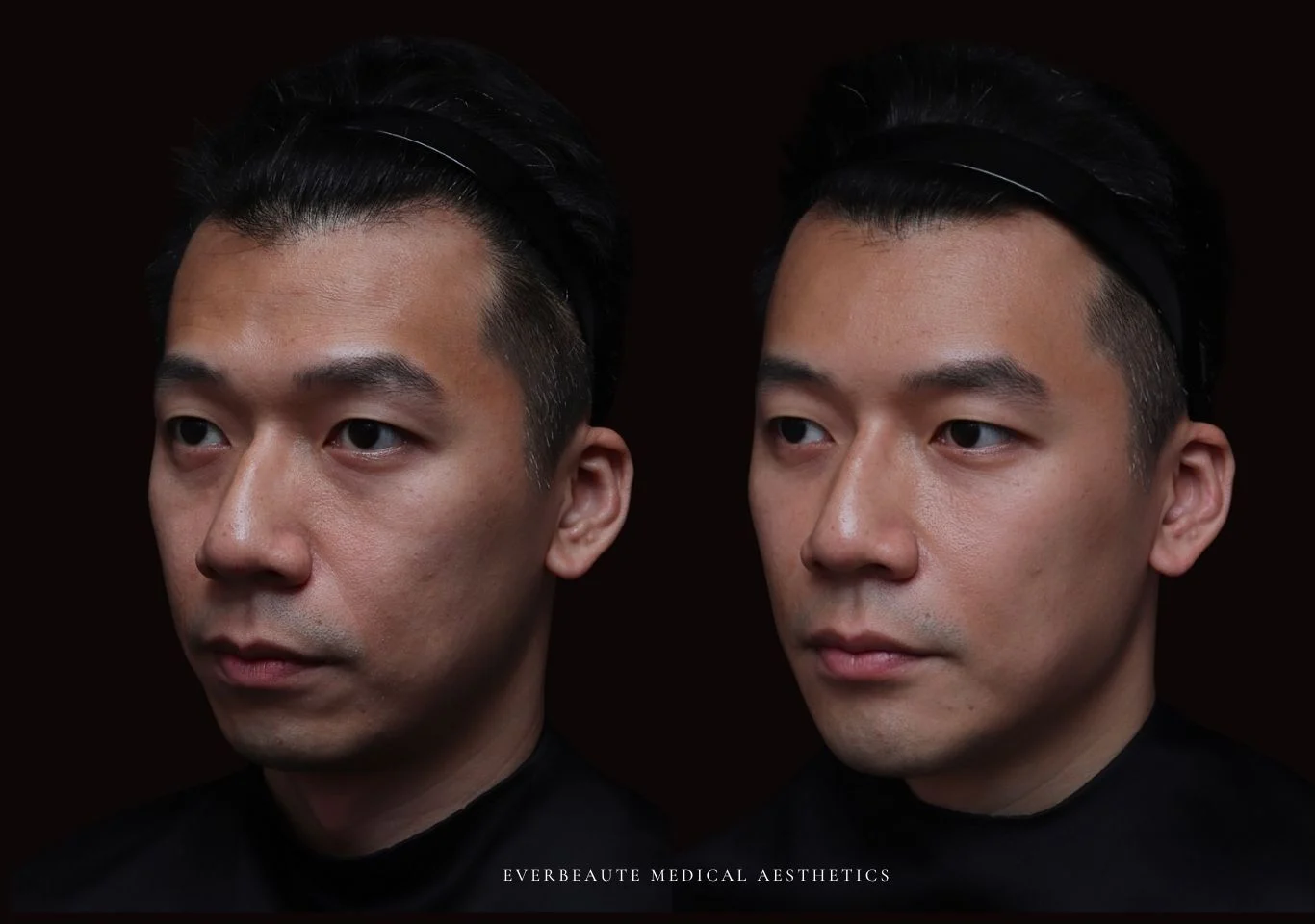 台北醫美推薦 大安區醫美 桃園微整 淚溝 眼袋 黑眼圈 豐唇 木偶紋 凝境美學診所 曾繁聞醫師 于曉恩醫師 皮膚科 專科 專業 效果自然 微整形 填補 填充 瑞士緹奧希 玻尿酸 喬雅登 水無痕 保柔緹 女神動態 熊貓針 淚溝針 童顏針 伊蓮絲 精靈針 喬雅露 逆時針 價格 副作用 後遺症 dcard ptt 成功案例 玻尿酸豐唇前後對比 豐唇、玻尿酸豐唇、自然豐唇、唇形改善、唇線重塑、唇峰設計、唇部微整形、豐唇注射推薦、自然飽滿唇、唇部玻尿酸 大安站醫美診所 豐額 額頭塑形 豐額填充 飽滿天庭 額頭飽滿 喬雅登玻尿酸 5