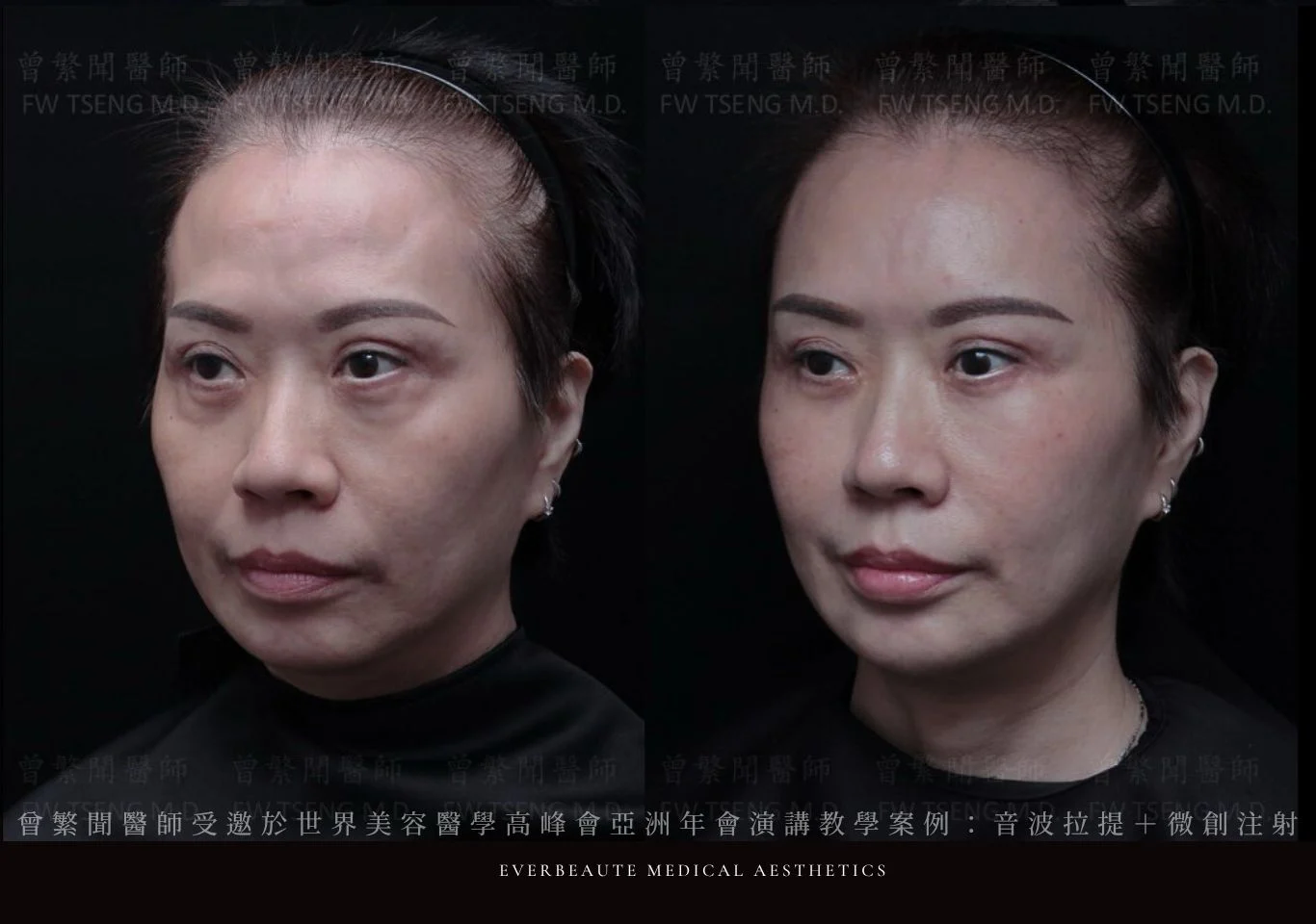 台北醫美推薦 大安區醫美 桃園微整 淚溝 眼袋 黑眼圈 豐唇 木偶紋 凝境美學診所 曾繁聞醫師 于曉恩醫師 皮膚科 專科 專業 效果自然 微整形 填補 填充 瑞士緹奧希 玻尿酸 喬雅登 水無痕 保柔緹 女神動態 熊貓針 淚溝針 童顏針 伊蓮絲 精靈針 喬雅露 逆時針 價格 副作用 後遺症 dcard ptt 成功案例 玻尿酸豐唇前後對比 豐唇、玻尿酸豐唇、自然豐唇、唇形改善、唇線重塑、唇峰設計、唇部微整形、豐唇注射推薦、自然飽滿唇、唇部玻尿酸 大安站醫美診所 豐額 額頭塑形 豐額填充 飽滿天庭 額頭飽滿 02