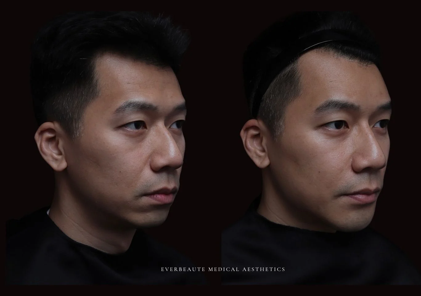 台北醫美推薦 大安區醫美 桃園微整 男性醫美 男生審美 男人有型 豐額頭 太陽穴填補 夫妻宮凹陷 淚溝 眼袋 黑眼圈 蘋果肌飽滿 法令紋填充 鼻基底凹陷 下巴短 下巴後縮 木偶紋 暴牙 嘴凸 下顎輪廓線 非手術 不動刀 無痕拉提 凝境美學診所 曾繁聞醫師 于曉恩醫師 皮膚科 專科 專業 好評 院長 原廠講師級 效果自然 微整形 填補 填充 瑞士緹奧希 玻尿酸 喬雅登 瑞絲朗 水無痕 保柔緹 女神動態 熊貓針 淚溝針 3D 4D聚左旋乳酸 童顏針 舒顏萃 伊蓮絲 Ellanse 艾麗斯 精靈針 喬雅露 薇貝拉 逆時針 熊貓針 膠原蛋白增生 價格 痛 副作用 後遺症 dcard ptt 成功案例3