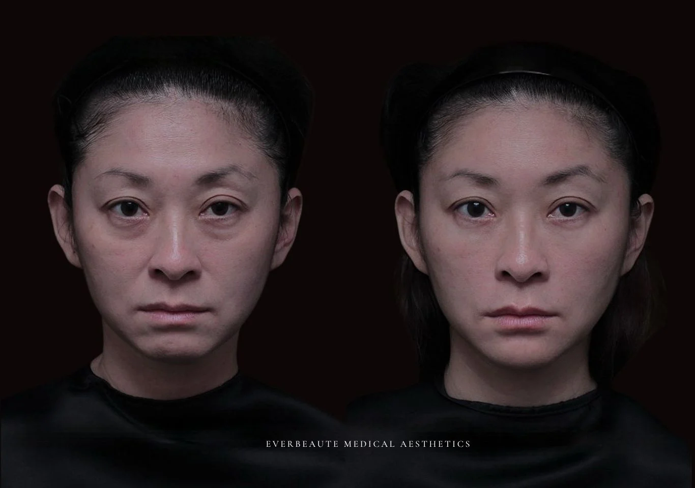 台北醫美推薦 大安區醫美 桃園微整 淚溝 眼袋 黑眼圈 豐唇 木偶紋 凝境美學診所 曾繁聞醫師 于曉恩醫師 皮膚科 專科 專業 效果自然 微整形 填補 填充 瑞士緹奧希 玻尿酸 喬雅登 水無痕 保柔緹 女神動態 熊貓針 淚溝針 童顏針 伊蓮絲 精靈針 喬雅露 逆時針 價格 副作用 後遺症 dcard ptt 成功案例 玻尿酸豐唇前後對比 豐唇、玻尿酸豐唇、自然豐唇、唇形改善、唇線重塑、唇峰設計、唇部微整形、豐唇注射推薦、自然飽滿唇、唇部玻尿酸 大安站醫美診所 豐額 額頭塑形 豐額填充 飽滿天庭 玻尿酸豐額