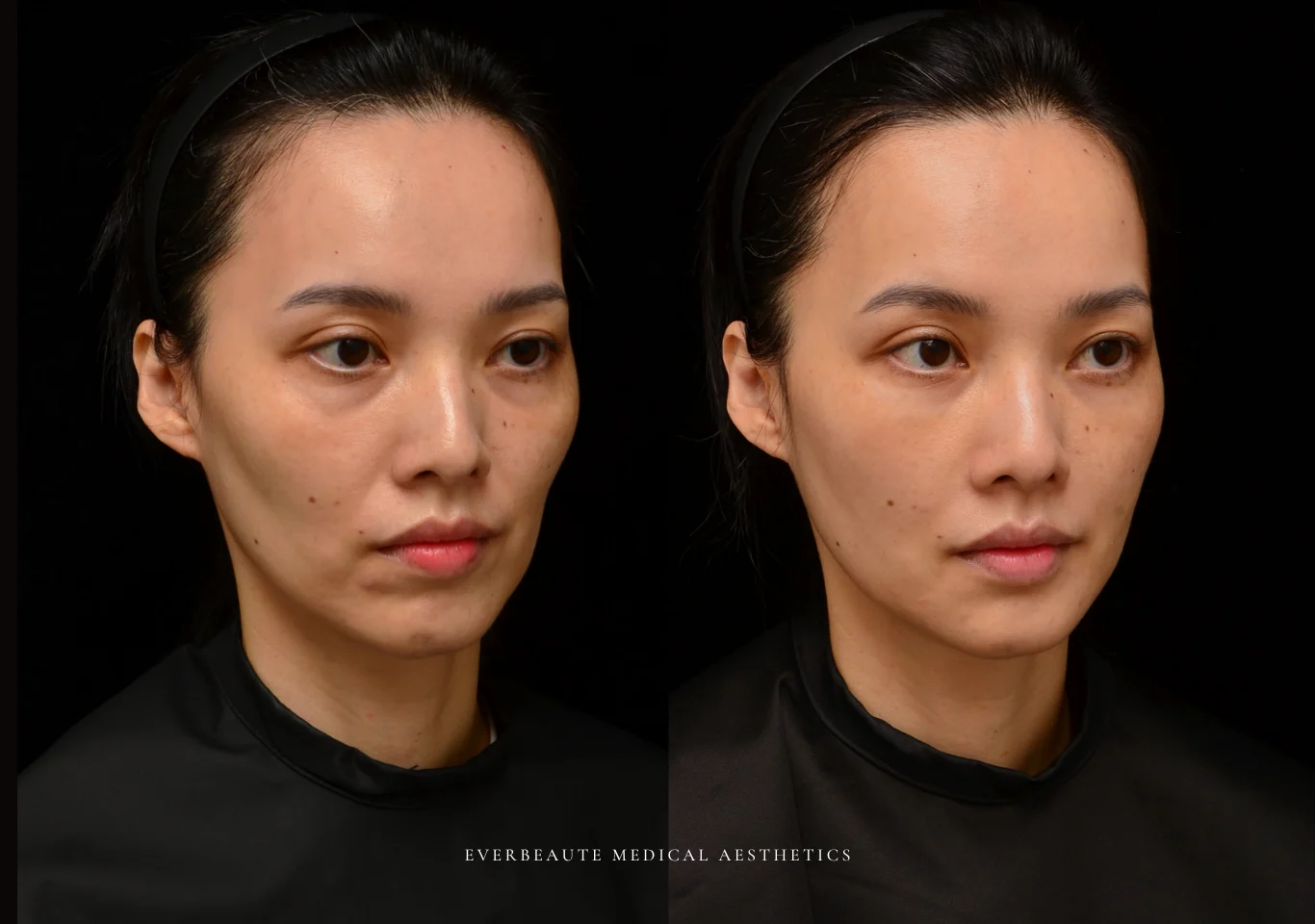 台北醫美推薦 大安區醫美 桃園微整 淚溝 眼袋 黑眼圈 木偶紋 法令紋 非手術 無痕拉提 凝境美學診所 曾繁聞醫師 于曉恩醫師 皮膚科 專科 專業 效果自然 微整形 填補 填充 瑞士緹奧希 玻尿酸 喬雅登 水無痕 保柔緹 女神動態 熊貓針 淚溝針 童顏針 伊蓮絲 精靈針 喬雅露 逆時針 價格 副作用 後遺症 dcard ptt 成功案例0003