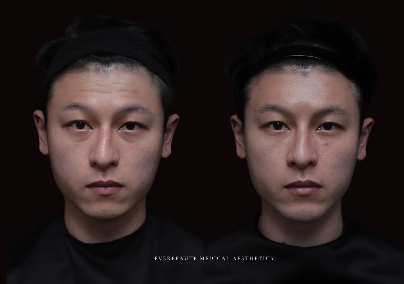 台北醫美推薦 大安區醫美 桃園微整 淚溝 眼袋 黑眼圈 豐唇 木偶紋 凝境美學診所 曾繁聞醫師 于曉恩醫師 皮膚科 專科 專業 效果自然 微整形 填補 填充 瑞士緹奧希 玻尿酸 喬雅登 水無痕 保柔緹 女神動態 熊貓針 淚溝針 童顏針 伊蓮絲 精靈針 喬雅露 逆時針 價格 副作用 後遺症 dcard ptt 成功案例 玻尿酸豐唇前後對比 豐唇、玻尿酸豐唇、自然豐唇、唇形改善、唇線重塑、唇峰設計、唇部微整形、豐唇注射推薦、自然飽滿唇、唇部玻尿酸 大安站醫美診所 豐額