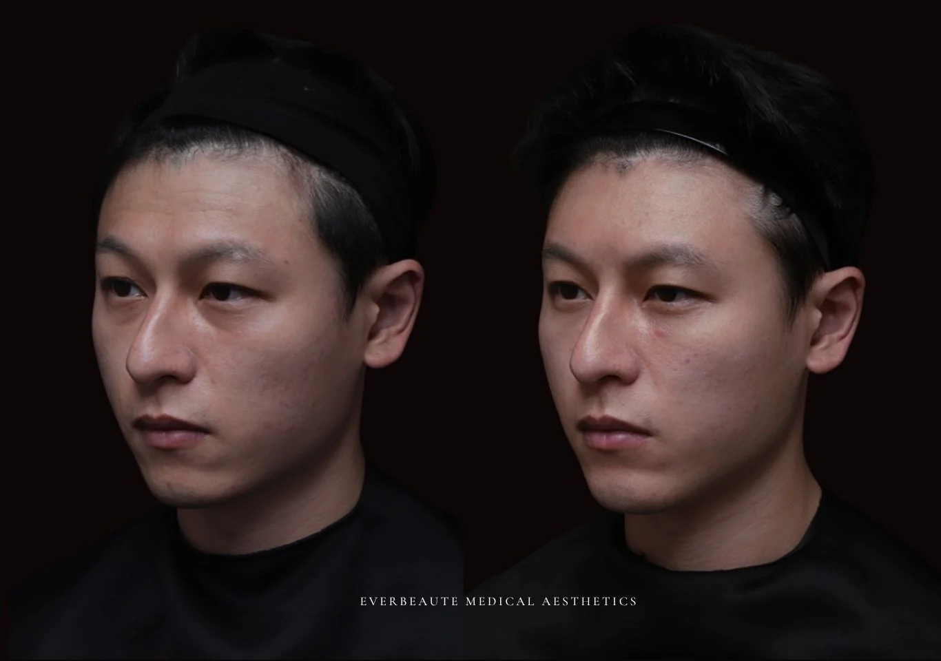 台北醫美推薦 大安區醫美 桃園微整 淚溝 眼袋 黑眼圈 豐唇 木偶紋 凝境美學診所 曾繁聞醫師 于曉恩醫師 皮膚科 專科 專業 效果自然 微整形 填補 填充 瑞士緹奧希 玻尿酸 喬雅登 水無痕 保柔緹 女神動態 熊貓針 淚溝針 童顏針 伊蓮絲 精靈針 喬雅露 逆時針 價格 副作用 後遺症 dcard ptt 成功案例 玻尿酸豐唇前後對比 豐唇、玻尿酸豐唇、自然豐唇、唇形改善、唇線重塑、唇峰設計、唇部微整形、豐唇注射推薦、自然飽滿唇、唇部玻尿酸 大安站醫美診所 豐額 1