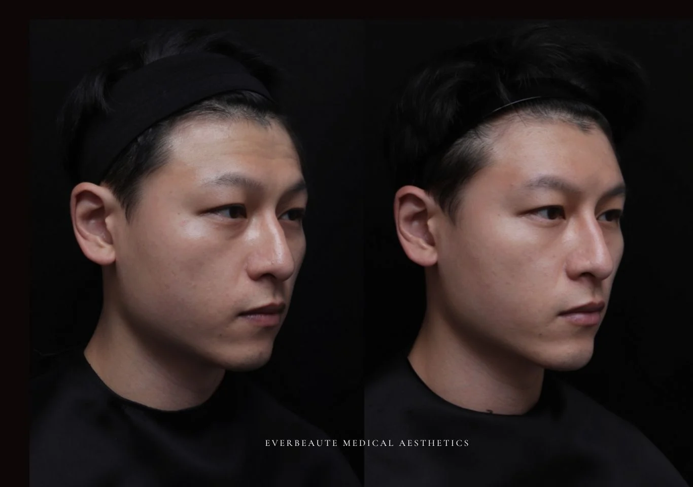 台北醫美推薦 大安區醫美 桃園微整 淚溝 眼袋 黑眼圈 豐唇 木偶紋 凝境美學診所 曾繁聞醫師 于曉恩醫師 皮膚科 專科 專業 效果自然 微整形 填補 填充 瑞士緹奧希 玻尿酸 喬雅登 水無痕 保柔緹 女神動態 熊貓針 淚溝針 童顏針 伊蓮絲 精靈針 喬雅露 逆時針 價格 副作用 後遺症 dcard ptt 成功案例 玻尿酸豐唇前後對比 豐唇、玻尿酸豐唇、自然豐唇、唇形改善、唇線重塑、唇峰設計、唇部微整形、豐唇注射推薦、自然飽滿唇、唇部玻尿酸 大安站醫美診所 豐額 2