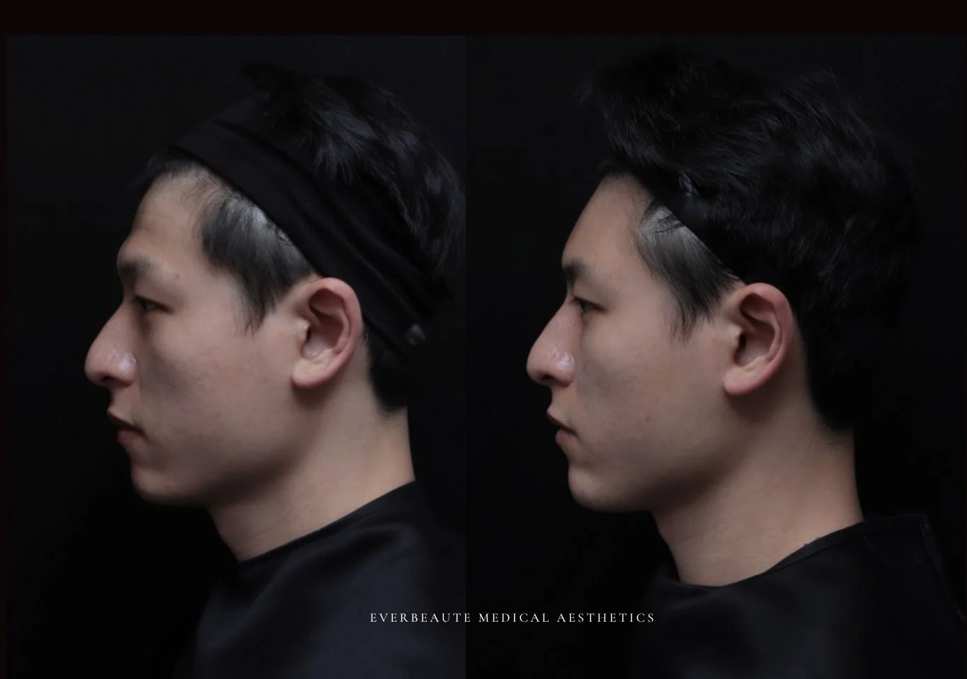 台北醫美推薦 大安區醫美 桃園微整 淚溝 眼袋 黑眼圈 豐唇 木偶紋 凝境美學診所 曾繁聞醫師 于曉恩醫師 皮膚科 專科 專業 效果自然 微整形 填補 填充 瑞士緹奧希 玻尿酸 喬雅登 水無痕 保柔緹 女神動態 熊貓針 淚溝針 童顏針 伊蓮絲 精靈針 喬雅露 逆時針 價格 副作用 後遺症 dcard ptt 成功案例 玻尿酸豐唇前後對比 豐唇、玻尿酸豐唇、自然豐唇、唇形改善、唇線重塑、唇峰設計、唇部微整形、豐唇注射推薦、自然飽滿唇、唇部玻尿酸 大安站醫美診所 豐額 3