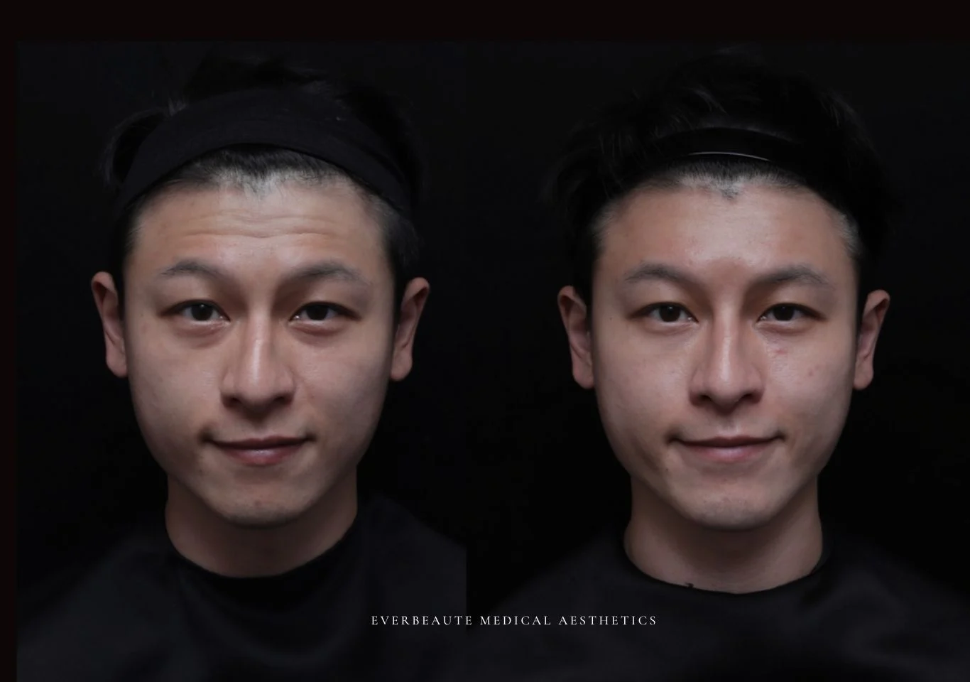 台北醫美推薦 大安區醫美 桃園微整 淚溝 眼袋 黑眼圈 豐唇 木偶紋 凝境美學診所 曾繁聞醫師 于曉恩醫師 皮膚科 專科 專業 效果自然 微整形 填補 填充 瑞士緹奧希 玻尿酸 喬雅登 水無痕 保柔緹 女神動態 熊貓針 淚溝針 童顏針 伊蓮絲 精靈針 喬雅露 逆時針 價格 副作用 後遺症 dcard ptt 成功案例 玻尿酸豐唇前後對比 豐唇、玻尿酸豐唇、自然豐唇、唇形改善、唇線重塑、唇峰設計、唇部微整形、豐唇注射推薦、自然飽滿唇、唇部玻尿酸 大安站醫美診所 豐額 4