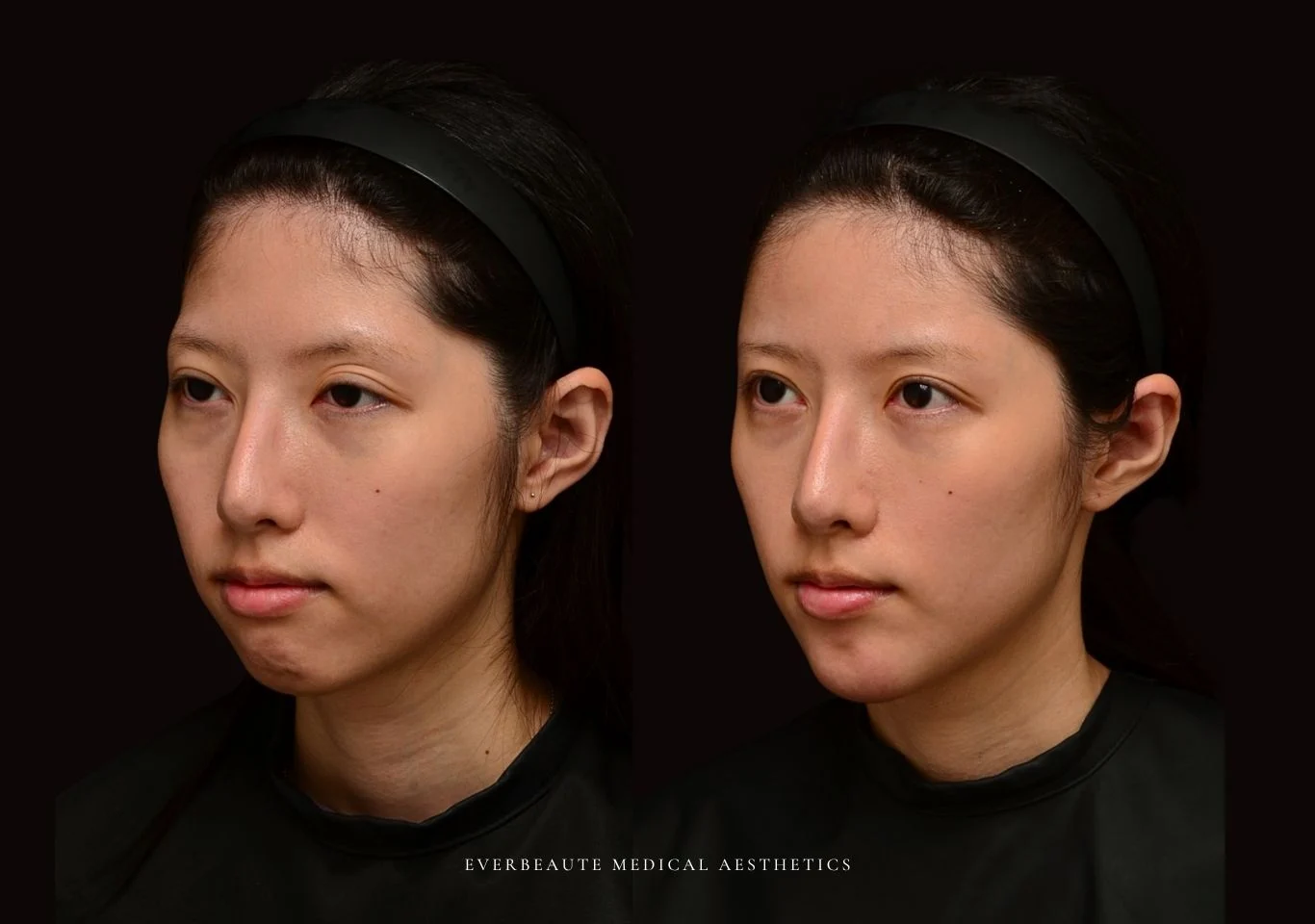 台北醫美推薦 大安區醫美 桃園微整 豐額頭 太陽穴填補 夫妻宮凹陷 上眼窩凹陷 淚溝 眼袋 黑眼圈 鼻基底凹陷 下巴後縮 木偶紋 下顎輪廓線 非手術 不動刀 無痕拉提 凝境美學診所 曾繁聞醫師 于曉恩醫師 皮膚科 專科 專業 好評 院長 原廠講師級 效果自然 微整形 填補 填充 瑞士緹奧希 玻尿酸 喬雅登 水無痕 保柔緹 女神動態 熊貓針 淚溝針 3D 4D聚左旋乳酸 童顏針 舒顏萃 伊蓮絲 Ellanse 艾麗斯 精靈針 喬雅露 薇貝拉 逆時針 熊貓針 膠原蛋白增生 價格 痛 副作用 後遺症 dcard ptt 成功案例1