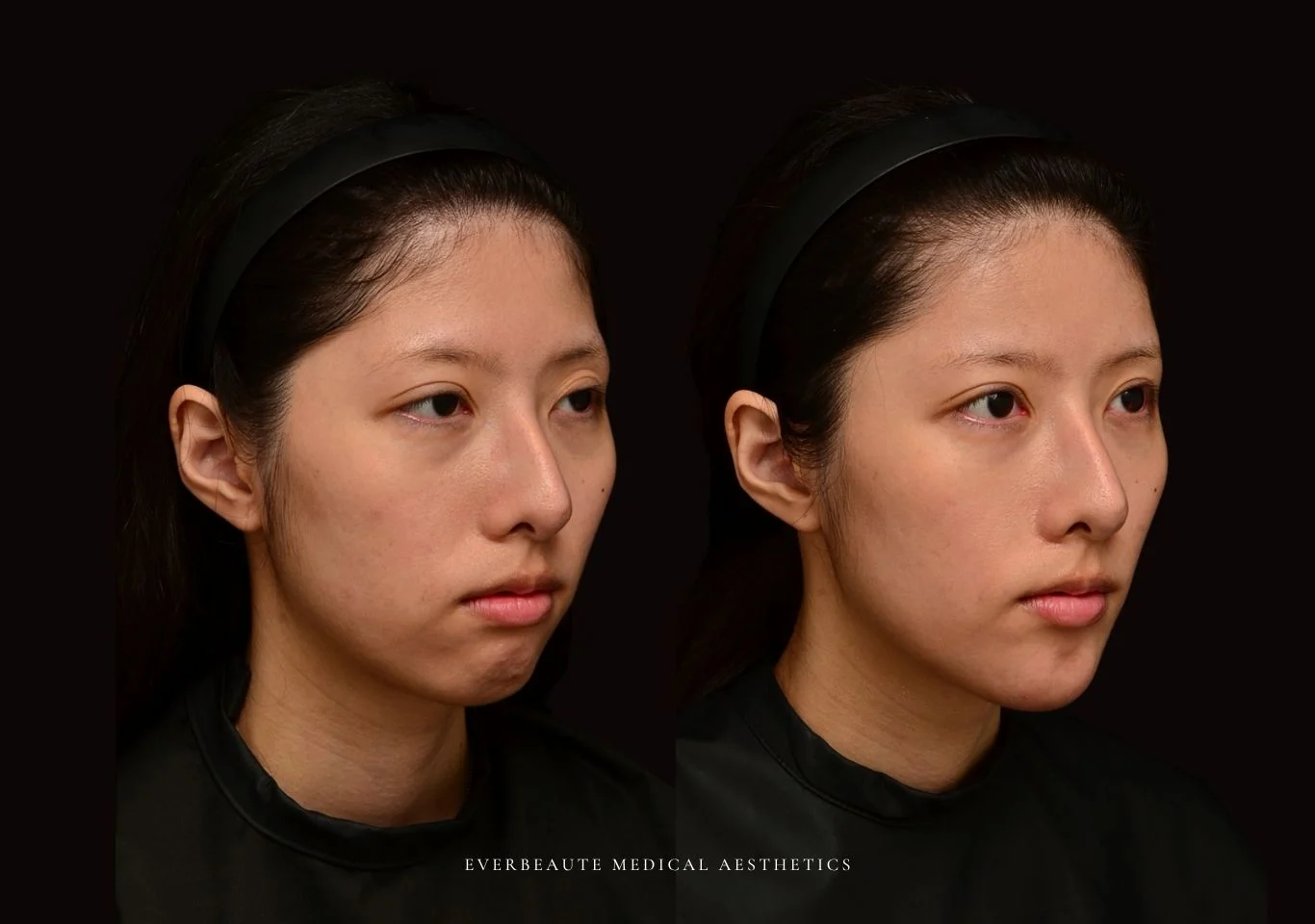 台北醫美推薦 大安區醫美 桃園微整 豐額頭 太陽穴填補 夫妻宮凹陷 上眼窩凹陷 淚溝 眼袋 黑眼圈 鼻基底凹陷 下巴後縮 木偶紋 下顎輪廓線 非手術 不動刀 無痕拉提 凝境美學診所 曾繁聞醫師 于曉恩醫師 皮膚科 專科 專業 好評 院長 原廠講師級 效果自然 微整形 填補 填充 瑞士緹奧希 玻尿酸 喬雅登 水無痕 保柔緹 女神動態 熊貓針 淚溝針 3D 4D聚左旋乳酸 童顏針 舒顏萃 伊蓮絲 Ellanse 艾麗斯 精靈針 喬雅露 薇貝拉 逆時針 熊貓針 膠原蛋白增生 價格 痛 副作用 後遺症 dcard ptt 成功案例4