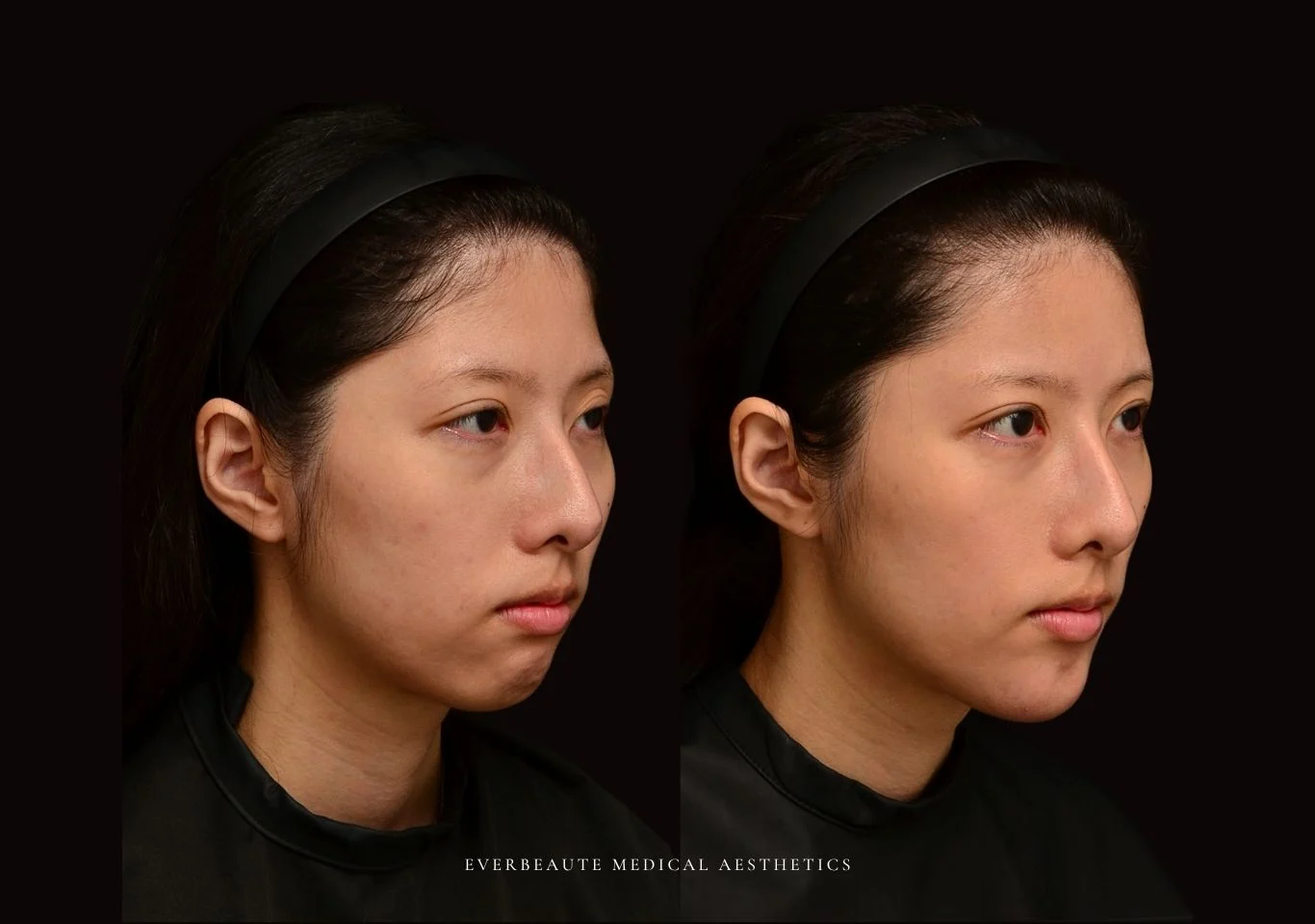 台北醫美推薦 大安區醫美 桃園微整 豐額頭 太陽穴填補 夫妻宮凹陷 上眼窩凹陷 淚溝 眼袋 黑眼圈 鼻基底凹陷 下巴後縮 木偶紋 下顎輪廓線 非手術 不動刀 無痕拉提 凝境美學診所 曾繁聞醫師 于曉恩醫師 皮膚科 專科 專業 好評 院長 原廠講師級 效果自然 微整形 填補 填充 瑞士緹奧希 玻尿酸 喬雅登 水無痕 保柔緹 女神動態 熊貓針 淚溝針 3D 4D聚左旋乳酸 童顏針 舒顏萃 伊蓮絲 Ellanse 艾麗斯 精靈針 喬雅露 薇貝拉 逆時針 熊貓針 膠原蛋白增生 價格 痛 副作用 後遺症 dcard ptt 成功案例5