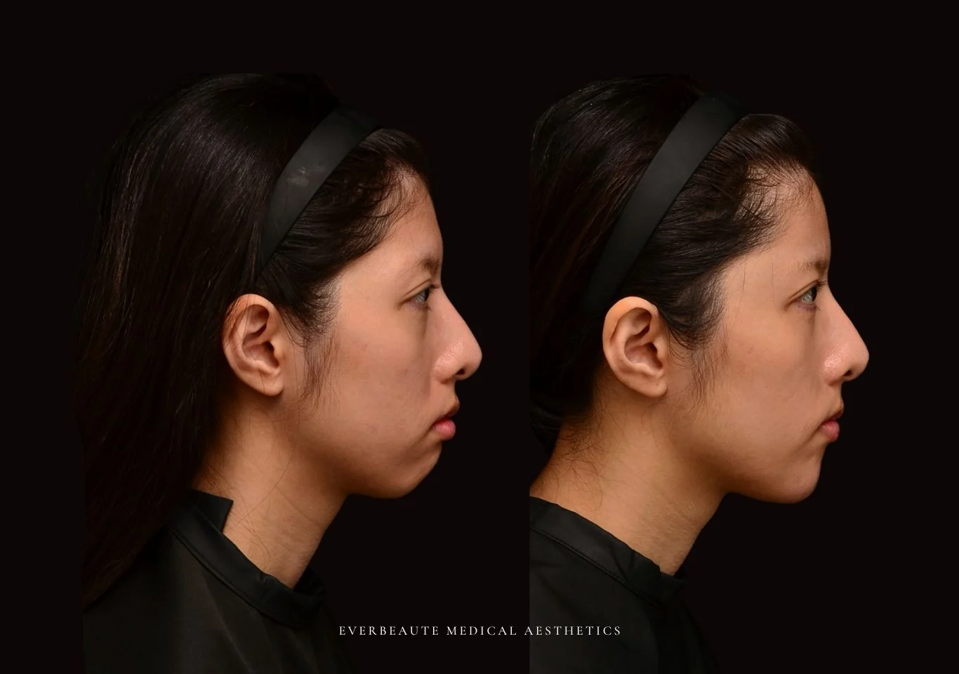 台北醫美推薦 大安區醫美 桃園微整 豐額頭 太陽穴填補 夫妻宮凹陷 上眼窩凹陷 淚溝 眼袋 黑眼圈 鼻基底凹陷 下巴後縮 木偶紋 下顎輪廓線 非手術 不動刀 無痕拉提 凝境美學診所 曾繁聞醫師 于曉恩醫師 皮膚科 專科 專業 好評 院長 原廠講師級 效果自然 微整形 填補 填充 瑞士緹奧希 玻尿酸 喬雅登 水無痕 保柔緹 女神動態 熊貓針 淚溝針 3D 4D聚左旋乳酸 童顏針 舒顏萃 伊蓮絲 Ellanse 艾麗斯 精靈針 喬雅露 薇貝拉 逆時針 熊貓針 膠原蛋白增生 價格 痛 副作用 後遺症 dcard ptt 成功案例6