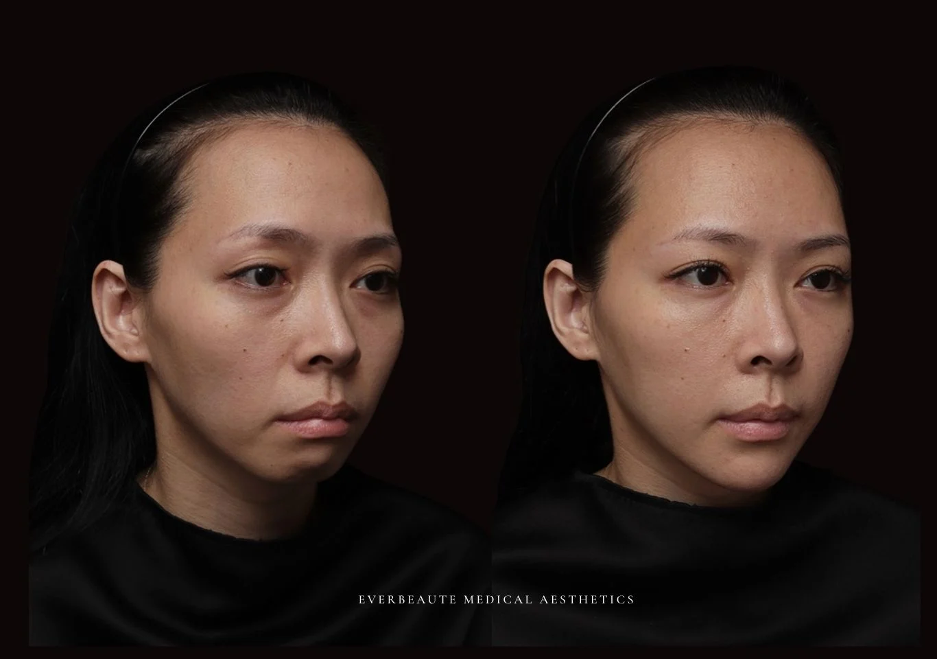 台北醫美推薦 大安區醫美 桃園微整 淚溝 眼袋 黑眼圈 木偶紋 蘋果肌 印地安紋 貓咪紋 嘴邊肉下垂 非手術 無痕拉提 凝境美學診所 曾繁聞醫師 于曉恩醫師 皮膚科 專科 專業 效果自然 微整形 填補 填充 瑞士緹奧希 玻尿酸 喬雅登 水無痕 保柔緹 女神動態 熊貓針 淚溝針 童顏針 伊蓮絲 精靈針 喬雅露 逆時針 價格 副作用 後遺症 dcard ptt 成功案例 雙下巴 下顎線 台北醫美