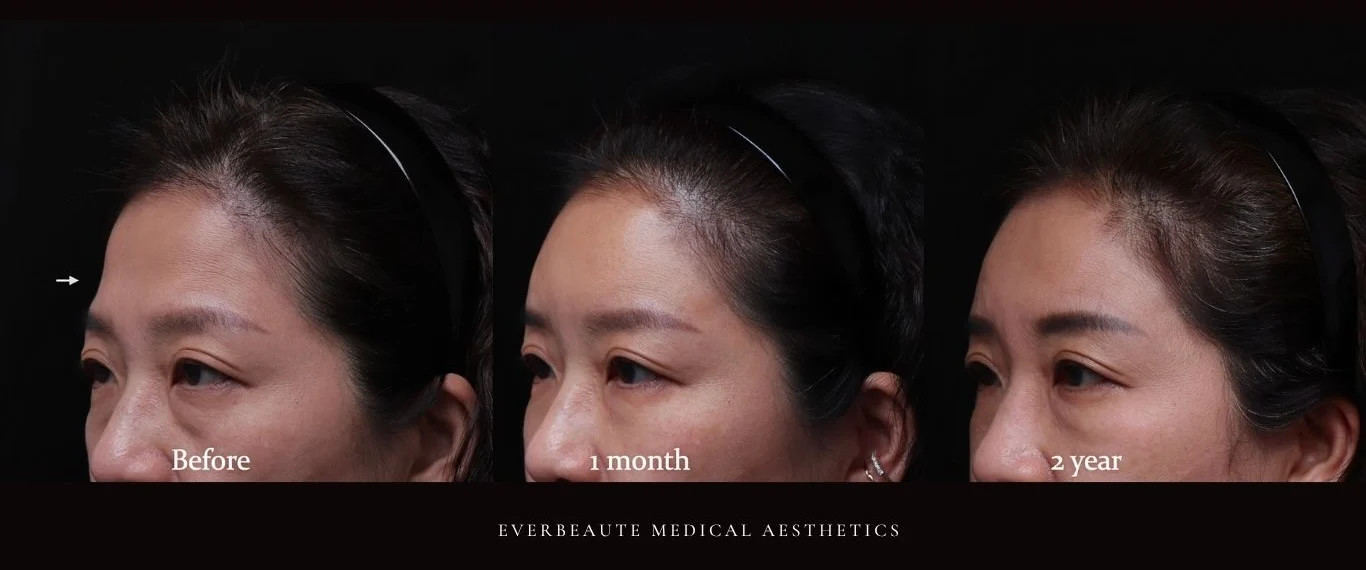 台北醫美推薦 大安區醫美 桃園微整 淚溝 眼袋 黑眼圈 豐唇 木偶紋 凝境美學診所 曾繁聞醫師 于曉恩醫師 皮膚科 專科 專業 效果自然 微整形 填補 填充 瑞士緹奧希 玻尿酸 喬雅登 水無痕 保柔緹 女神動態 熊貓針 淚溝針 童顏針 伊蓮絲 精靈針 喬雅露 逆時針 價格 副作用 後遺症 dcard ptt 成功案例 玻尿酸豐唇前後對比 豐唇、玻尿酸豐唇、自然豐唇、唇形改善、唇線重塑、唇峰設計、唇部微整形、豐唇注射推薦、自然飽滿唇、唇部玻尿酸 大安站醫美診所 豐額 額頭塑形 豐額填充 飽滿天庭 額頭飽滿 喬雅登玻尿酸 5555