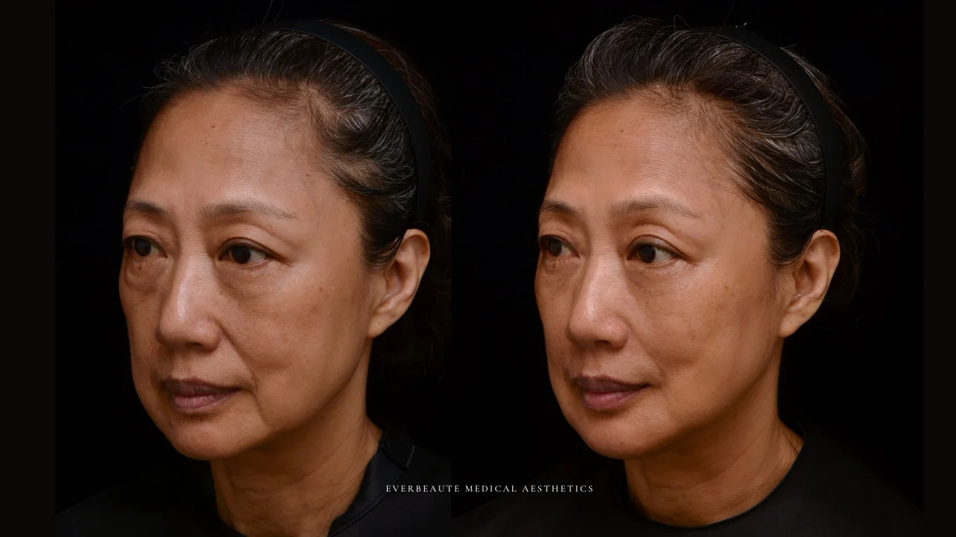 台北醫美推薦 大安區醫美 桃園微整 淚溝 眼袋 黑眼圈 木偶紋 蘋果肌 印地安紋 貓咪紋 嘴邊肉下垂 非手術 無痕拉提 凝境美學診所 曾繁聞醫師 于曉恩醫師 皮膚科 專科 專業 效果自然 微整形 填補 填充 瑞士緹奧希 玻尿酸 喬雅登 水無痕 保柔緹 女神動態 熊貓針 淚溝針 童顏針 伊蓮絲 精靈針 喬雅露 逆時針 價格 副作用 後遺症 dcard ptt 成功案例 6