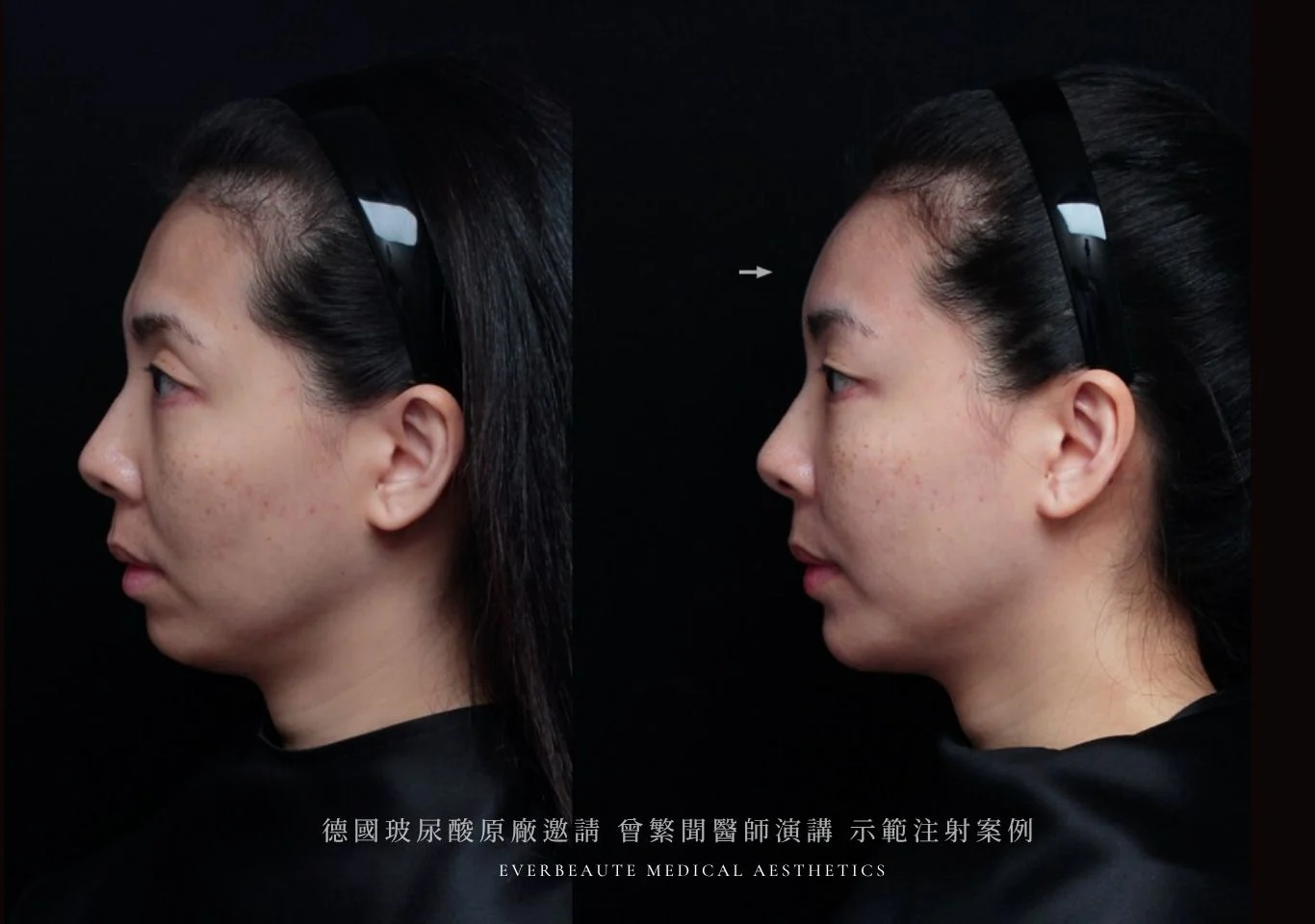 台北醫美推薦 大安區醫美 桃園微整 淚溝 眼袋 黑眼圈 豐唇 木偶紋 凝境美學診所 曾繁聞醫師 于曉恩醫師 皮膚科 專科 專業 效果自然 微整形 填補 填充 瑞士緹奧希 玻尿酸 喬雅登 水無痕 保柔緹 女神動態 熊貓針 淚溝針 童顏針 伊蓮絲 精靈針 喬雅露 逆時針 價格 副作用 後遺症 dcard ptt 成功案例 玻尿酸豐唇前後對比 豐唇、玻尿酸豐唇、自然豐唇、唇形改善、唇線重塑、唇峰設計、唇部微整形、豐唇注射推薦、自然飽滿唇、唇部玻尿酸 大安站醫美診所 豐額 額頭塑形 豐額填充 飽滿天庭 額頭飽滿 額頭注射 dcard