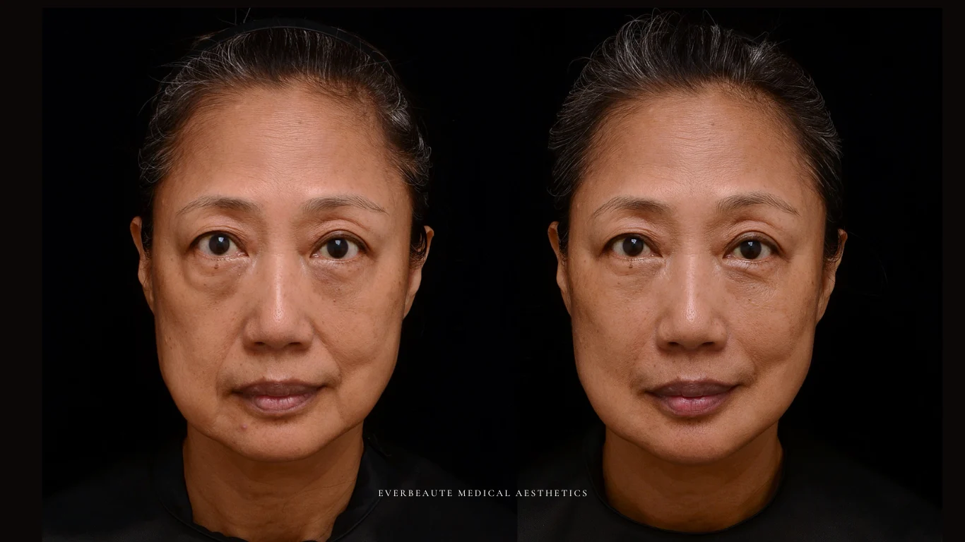 台北醫美推薦 大安區醫美 桃園微整 淚溝 眼袋 黑眼圈 木偶紋 蘋果肌 印地安紋 貓咪紋 嘴邊肉下垂 非手術 無痕拉提 凝境美學診所 曾繁聞醫師 于曉恩醫師 皮膚科 專科 專業 效果自然 微整形 填補 填充 瑞士緹奧希 玻尿酸 喬雅登 水無痕 保柔緹 女神動態 熊貓針 淚溝針 童顏針 伊蓮絲 精靈針 喬雅露 逆時針 價格 副作用 後遺症 dcard ptt 成功案例