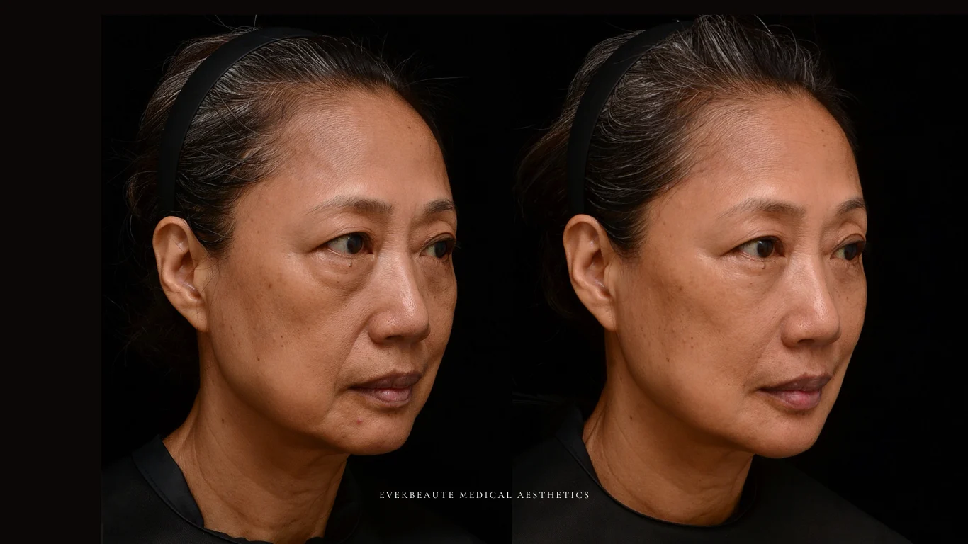 台北醫美推薦 大安區醫美 桃園微整 淚溝 眼袋 黑眼圈 木偶紋 蘋果肌 印地安紋 貓咪紋 嘴邊肉下垂 非手術 無痕拉提 凝境美學診所 曾繁聞醫師 于曉恩醫師 皮膚科 專科 專業 效果自然 微整形 填補 填充 瑞士緹奧希 玻尿酸 喬雅登 水無痕 保柔緹 女神動態 熊貓針 淚溝針 童顏針 伊蓮絲 精靈針 喬雅露 逆時針 價格 副作用 後遺症 dcard ptt 成功案例 1