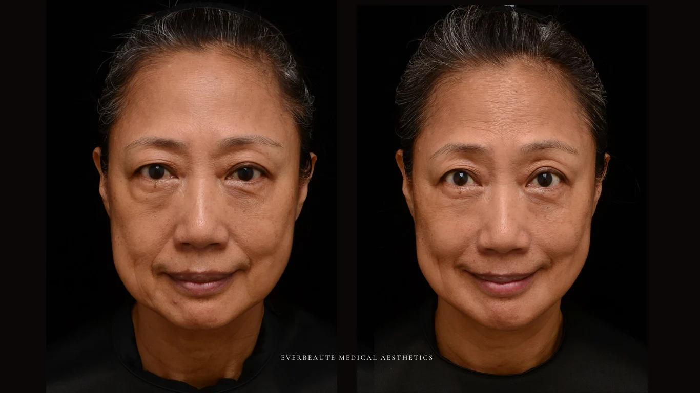 台北醫美推薦 大安區醫美 桃園微整 淚溝 眼袋 黑眼圈 木偶紋 蘋果肌 印地安紋 貓咪紋 嘴邊肉下垂 非手術 無痕拉提 凝境美學診所 曾繁聞醫師 于曉恩醫師 皮膚科 專科 專業 效果自然 微整形 填補 填充 瑞士緹奧希 玻尿酸 喬雅登 水無痕 保柔緹 女神動態 熊貓針 淚溝針 童顏針 伊蓮絲 精靈針 喬雅露 逆時針 價格 副作用 後遺症 dcard ptt 成功案例 4